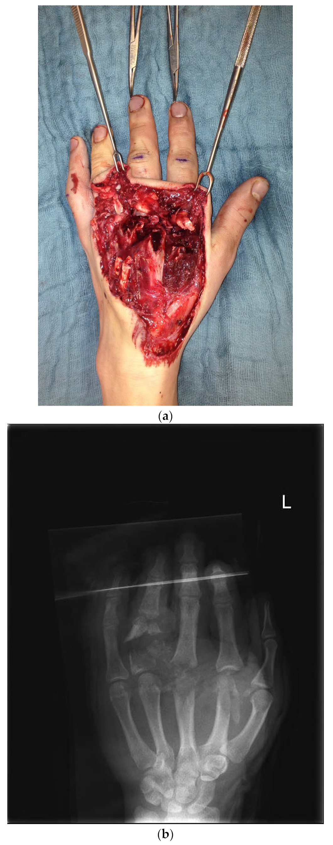 Surgical Management of Secondary Complex Microsurgical 