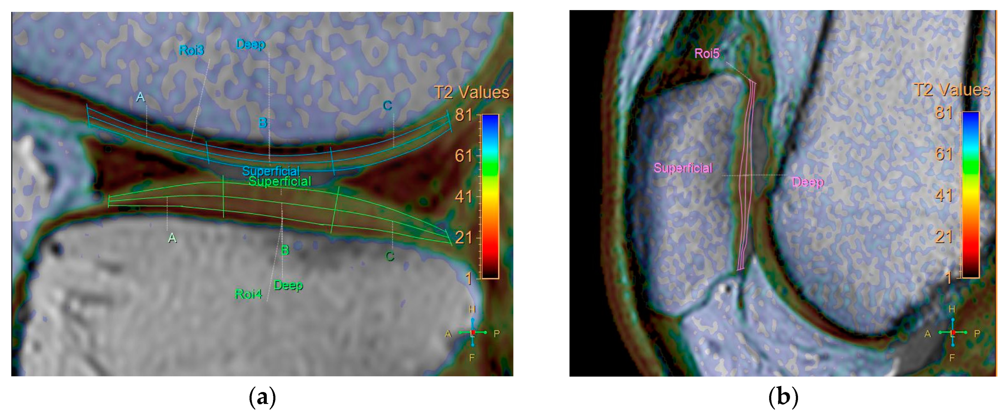 ls land image nude - 21- Effects of Intra-Articular Stromal Vascular Fraction Injection on Clinical  Symptoms and Cartilage Health in Osteoarthritic Knees: A Single-Center  Pilot Study