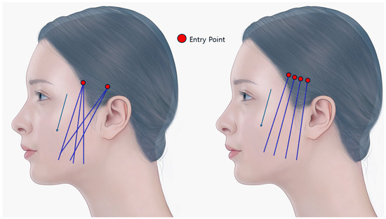 Pre- and Post-Procedural Considerations and Thread Types for Thread Lifting
