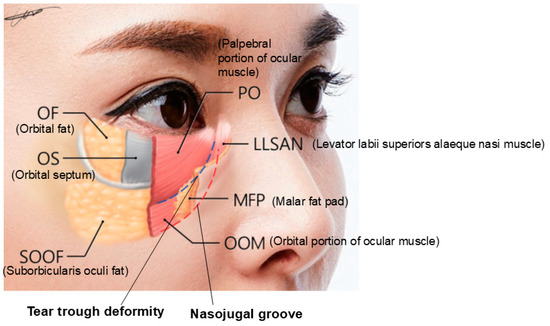 injection placements for under eye hollowness ghk-cu Enhance Your Tear Trough Treatment with Cheek Filler Where to Inject GHK-Cu: Best