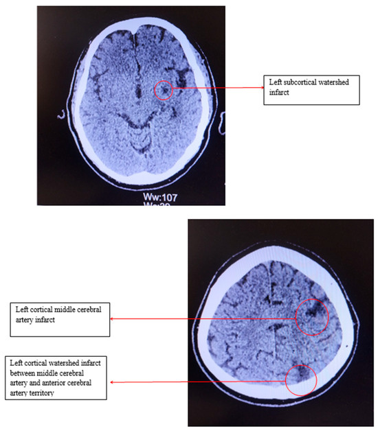 ENCYCLOPAEDIA of OCCLUSION【裁断済】 Unusual Evolution of Carotid Atherosclerosis in a Patient