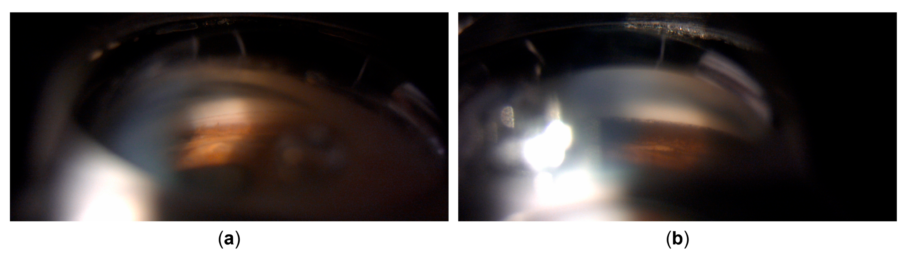 An Unusual Manifestation of HSV-1 Uveitis Transforming into