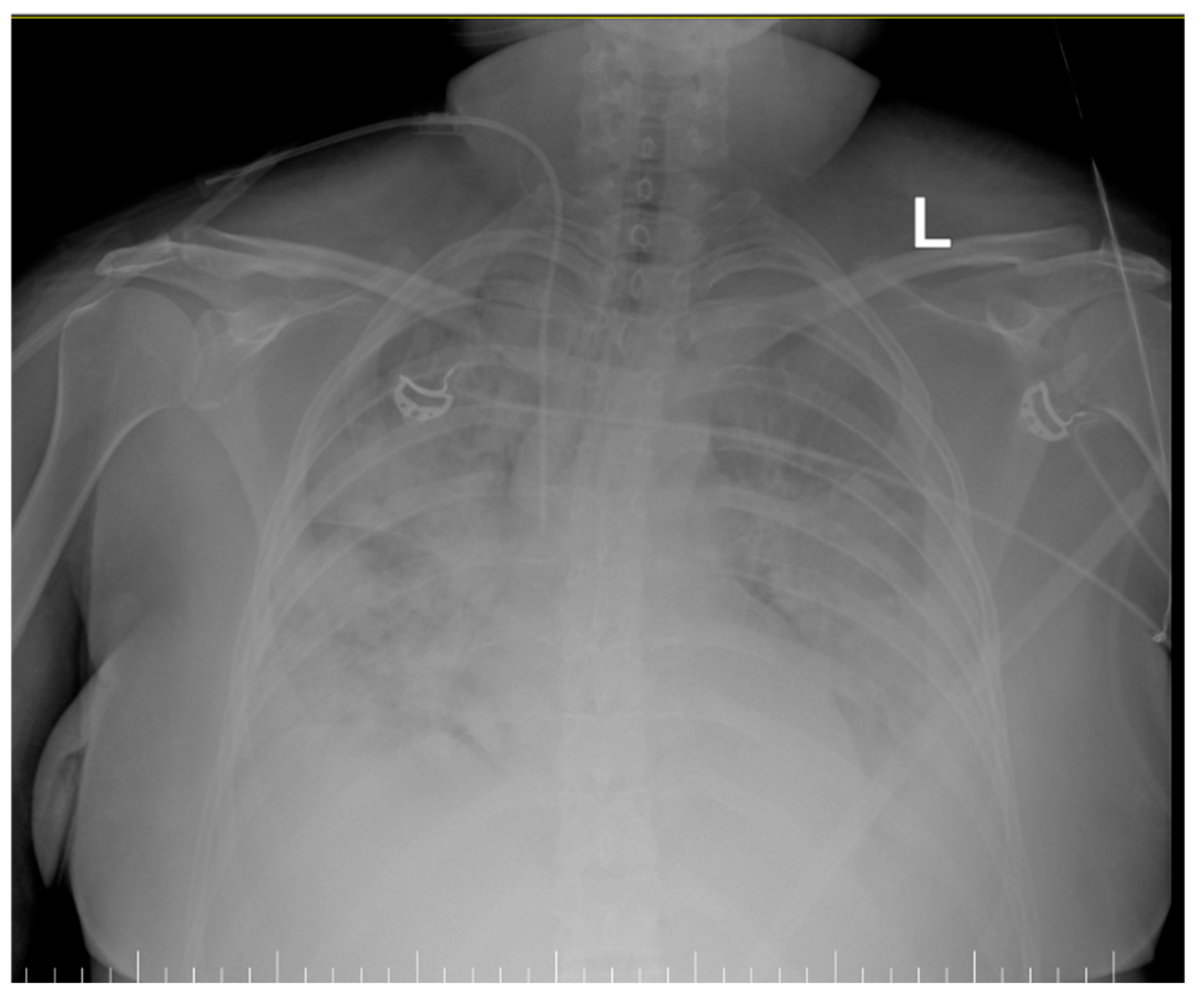 Too Late to Reverse: An Atypical Postpartum Case of Acute