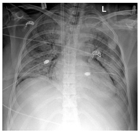 Too Late to Reverse: An Atypical Postpartum Case of Acute
