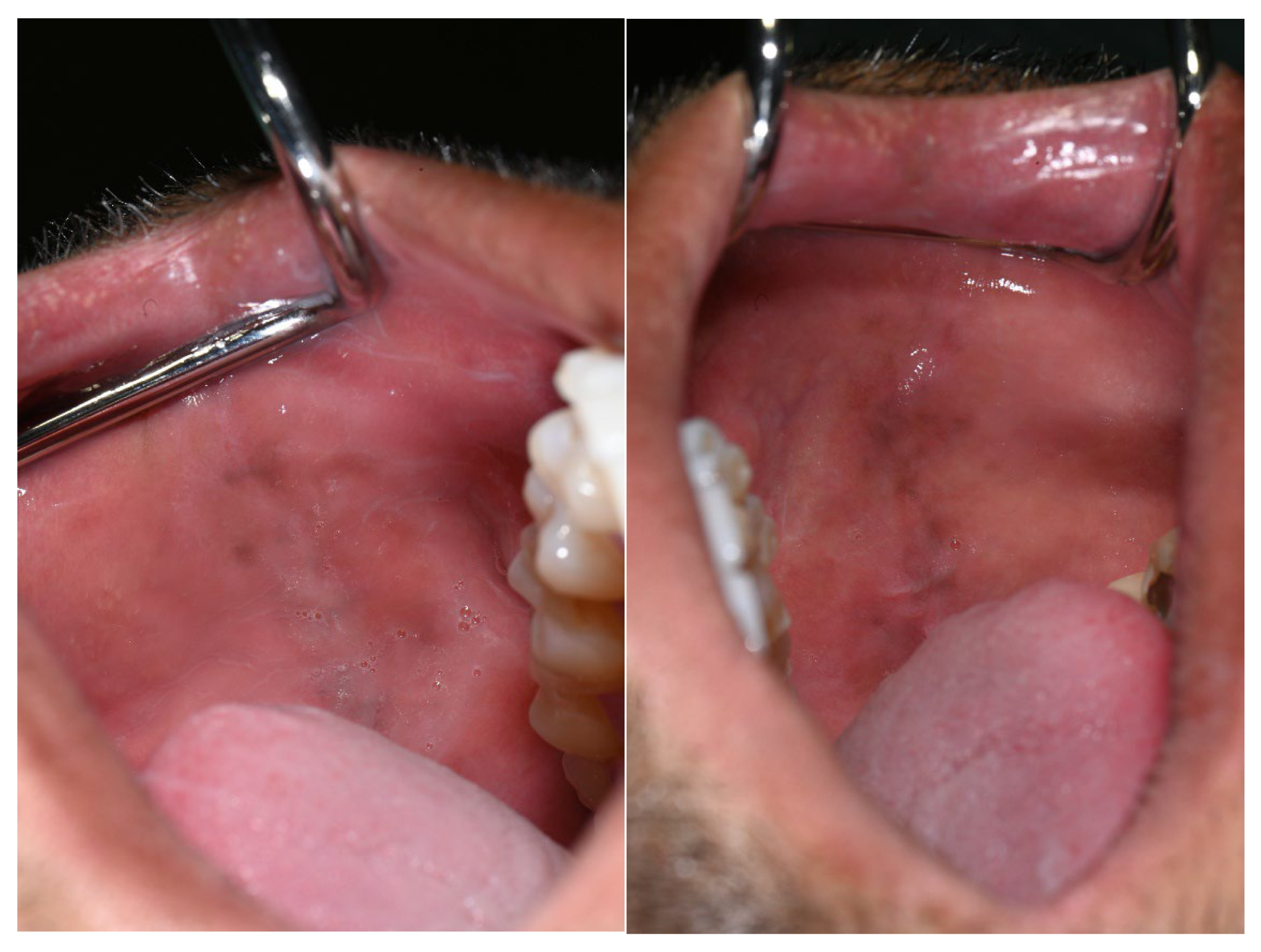 Changes in Oral Mucosa Associated with Melanotan II Injections: A Case Report Changes in Oral Mucosa Associated with Melanotan II Injections: A Case Report