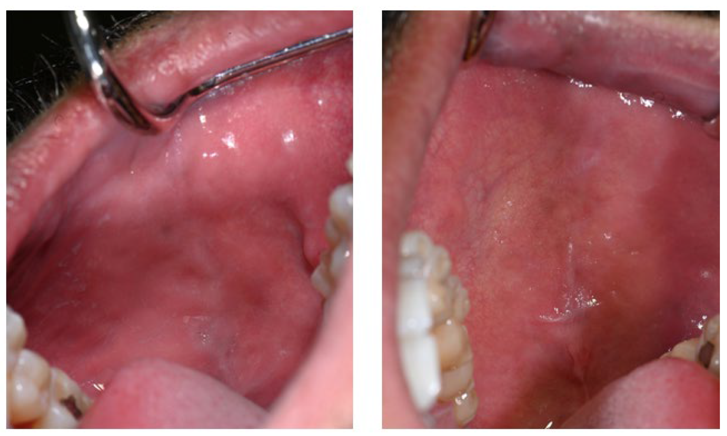 melanotan oral drops reviews Changes in Oral Mucosa Associated with Melanotan II Injections: A Case  Report