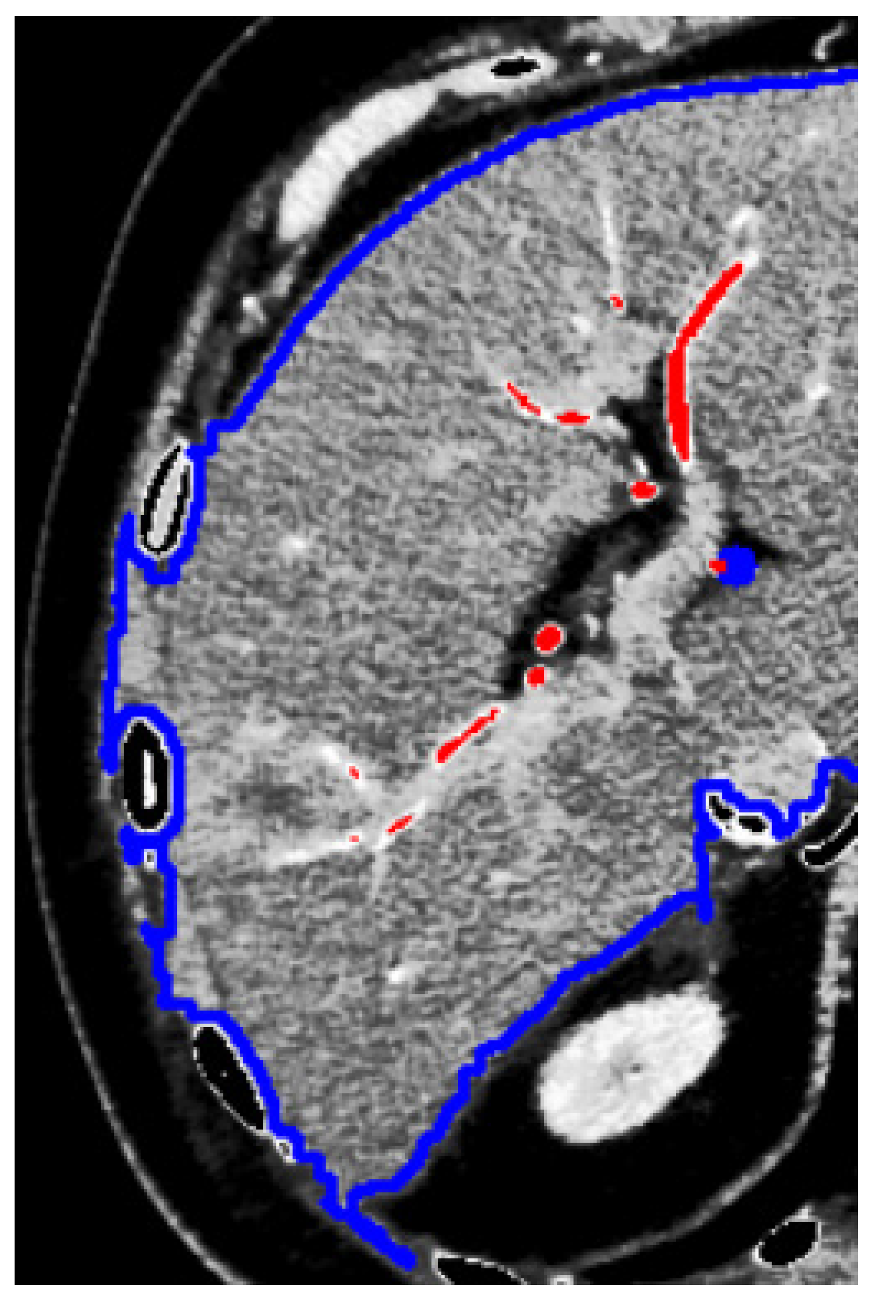 Automated liver tissues delineation techniques: A systematic