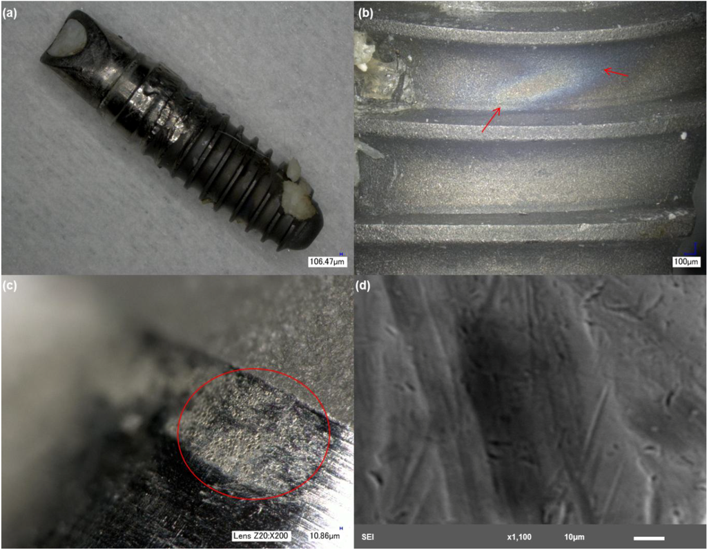 Titanium Corrosion Mechanisms in the Oral Environment A Retrieval Study
