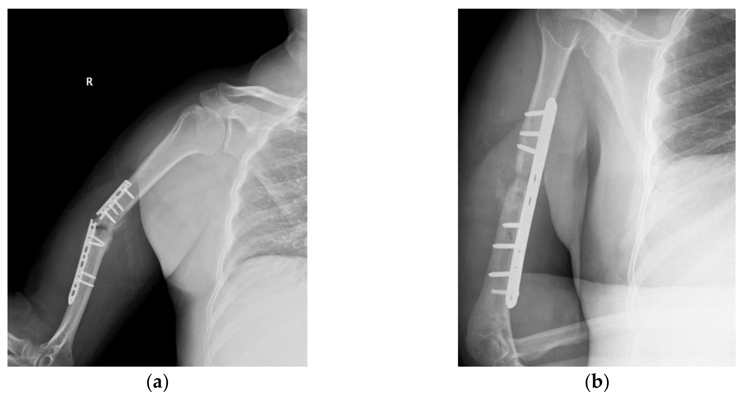 Materials Free FullText Failure Analysis of a Humeral Shaft