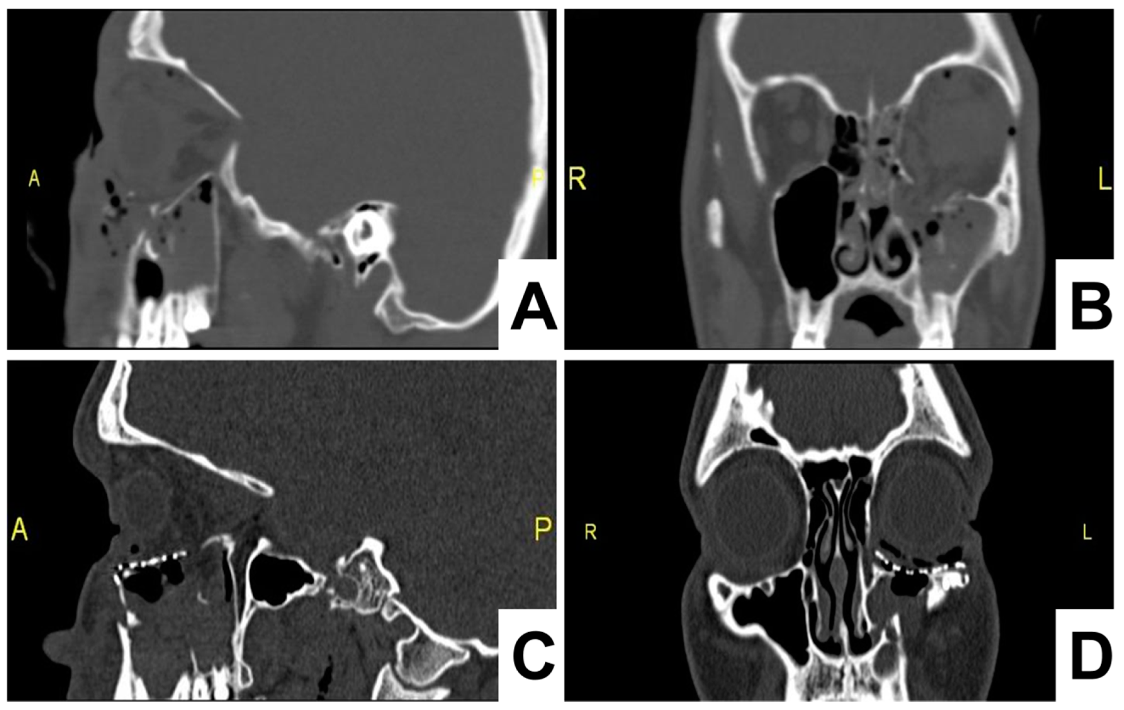 Materials Free Full Text Periorbital Reconstruction By