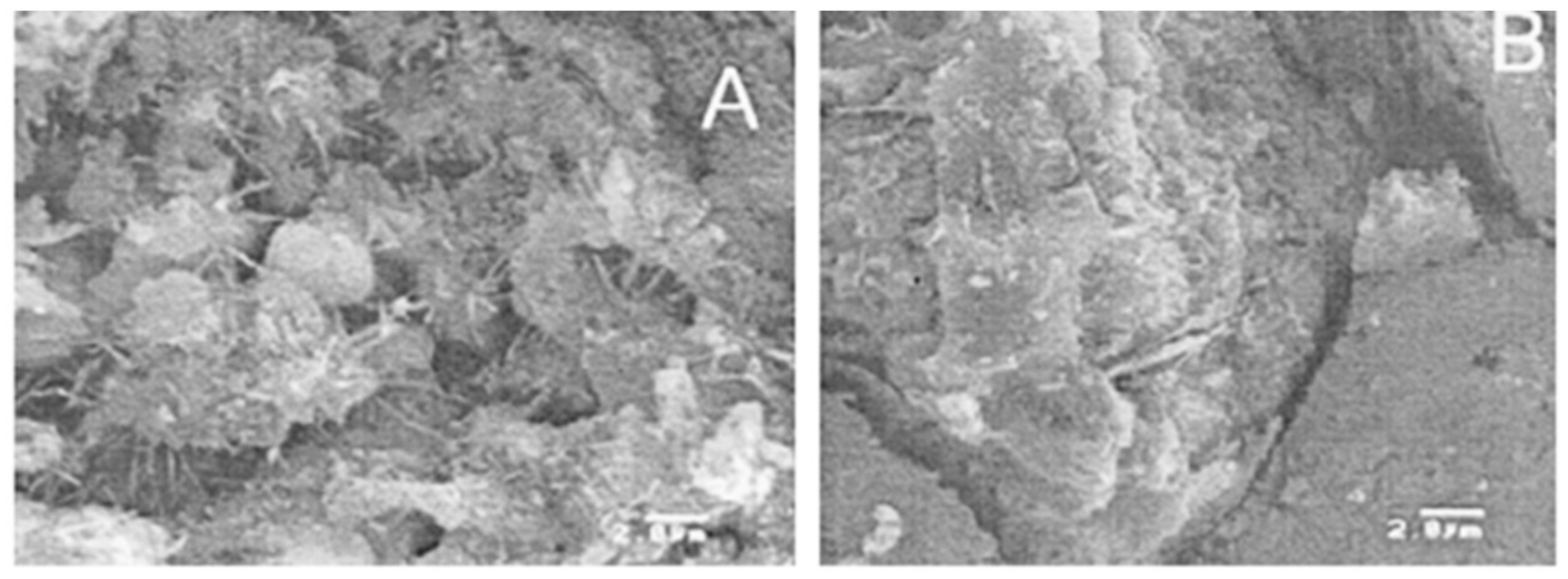 bone cancer causing pleural effusion