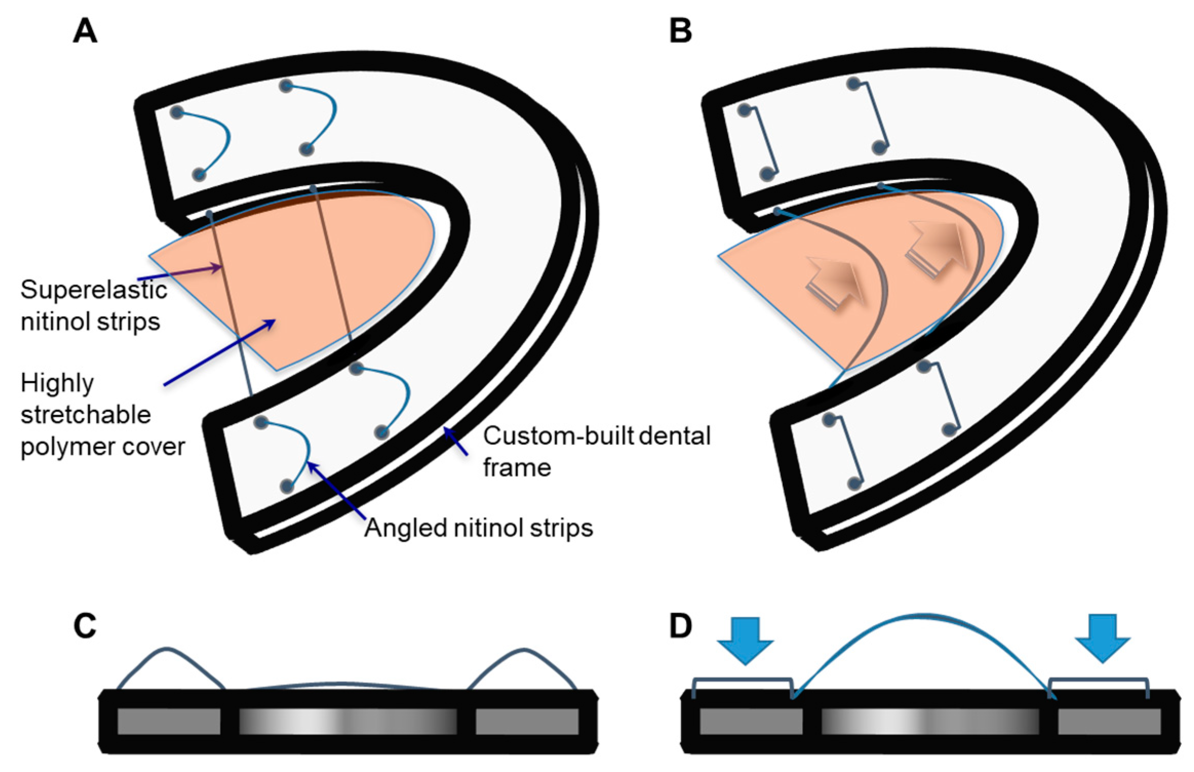 Materials Free FullText Use of Superelastic Nitinol and Highly
