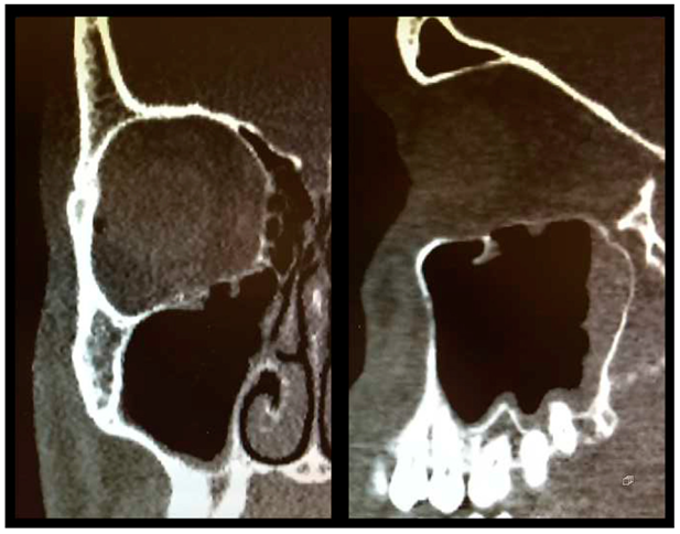 Essay On Orbital Fracture