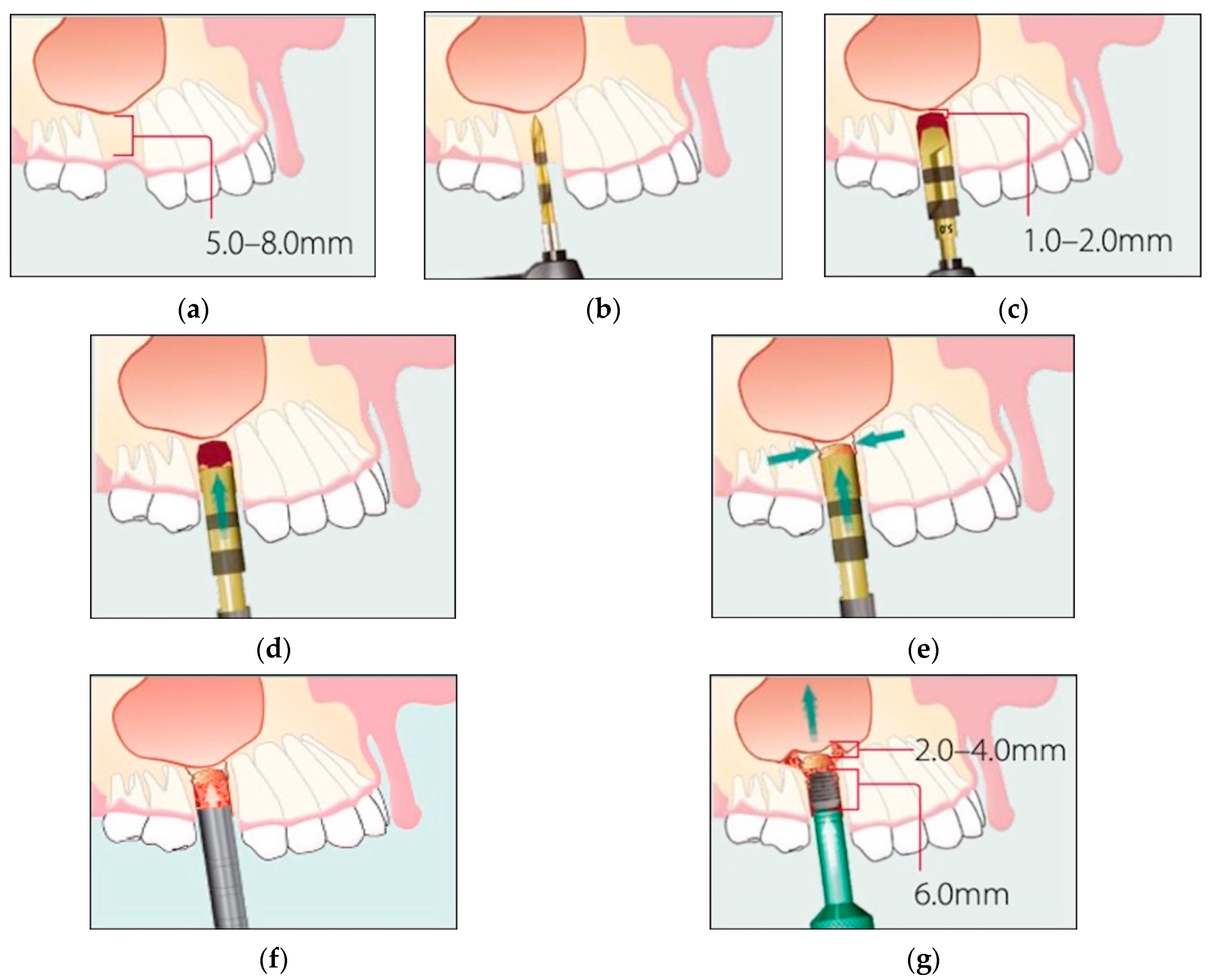 PDF) Vertical bone augmentation in a single-tooth gap with an allogenic bone  ring: Clinical considerations