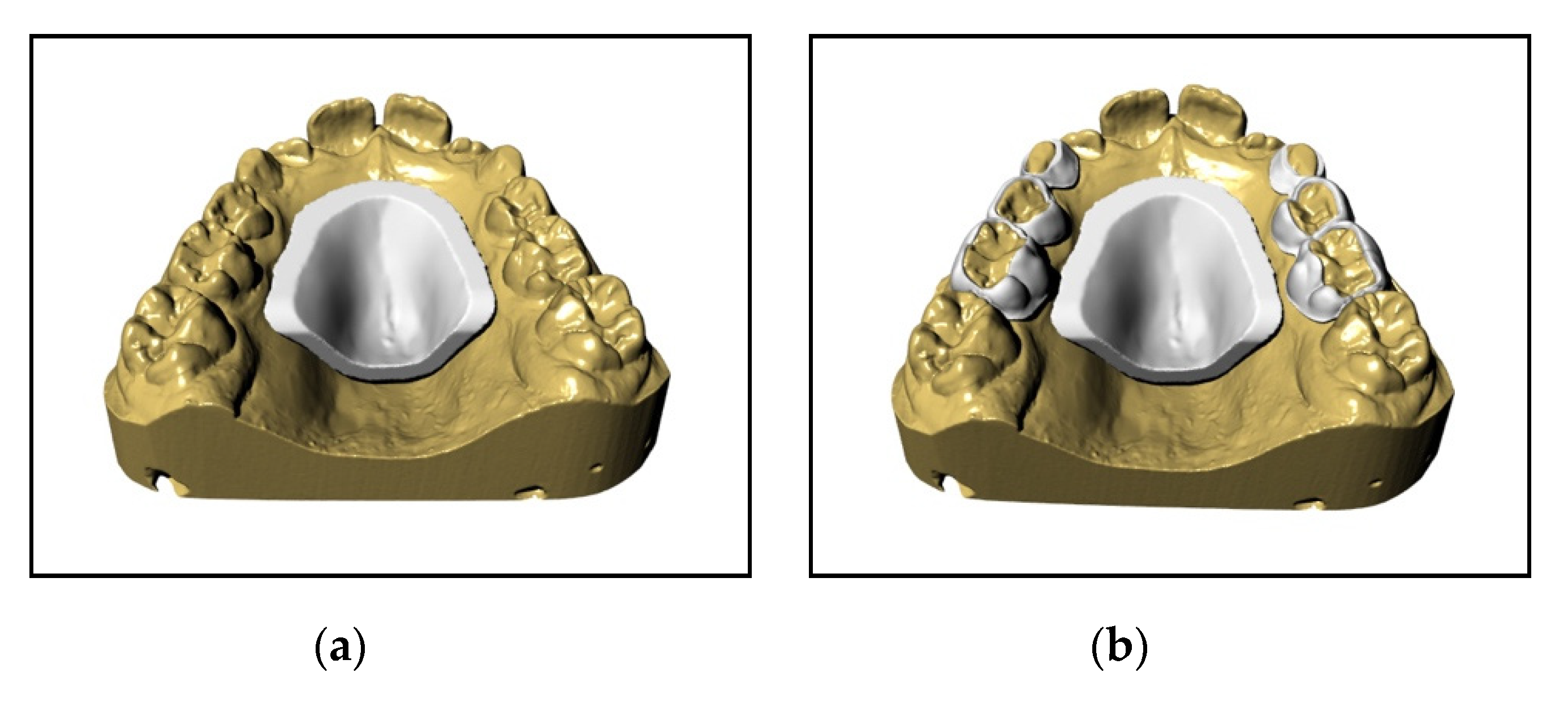 Materials Free Full Text A New Proposal A Digital Flow For The Construction Of A Haas Inspired Rapid Maxillary Expander Hirme Html