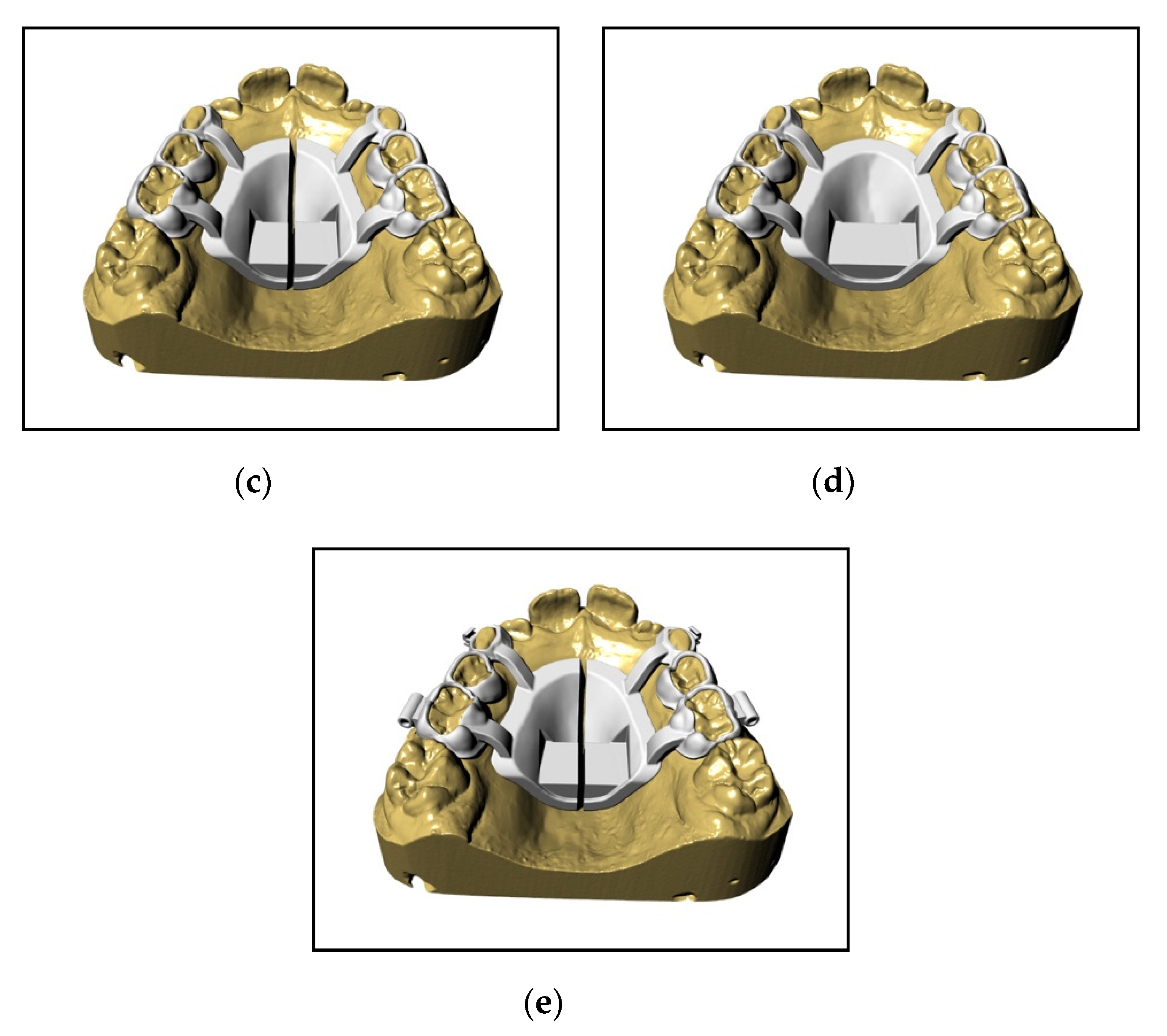 Materials Free Full Text A New Proposal A Digital Flow For The Construction Of A Haas Inspired Rapid Maxillary Expander Hirme Html