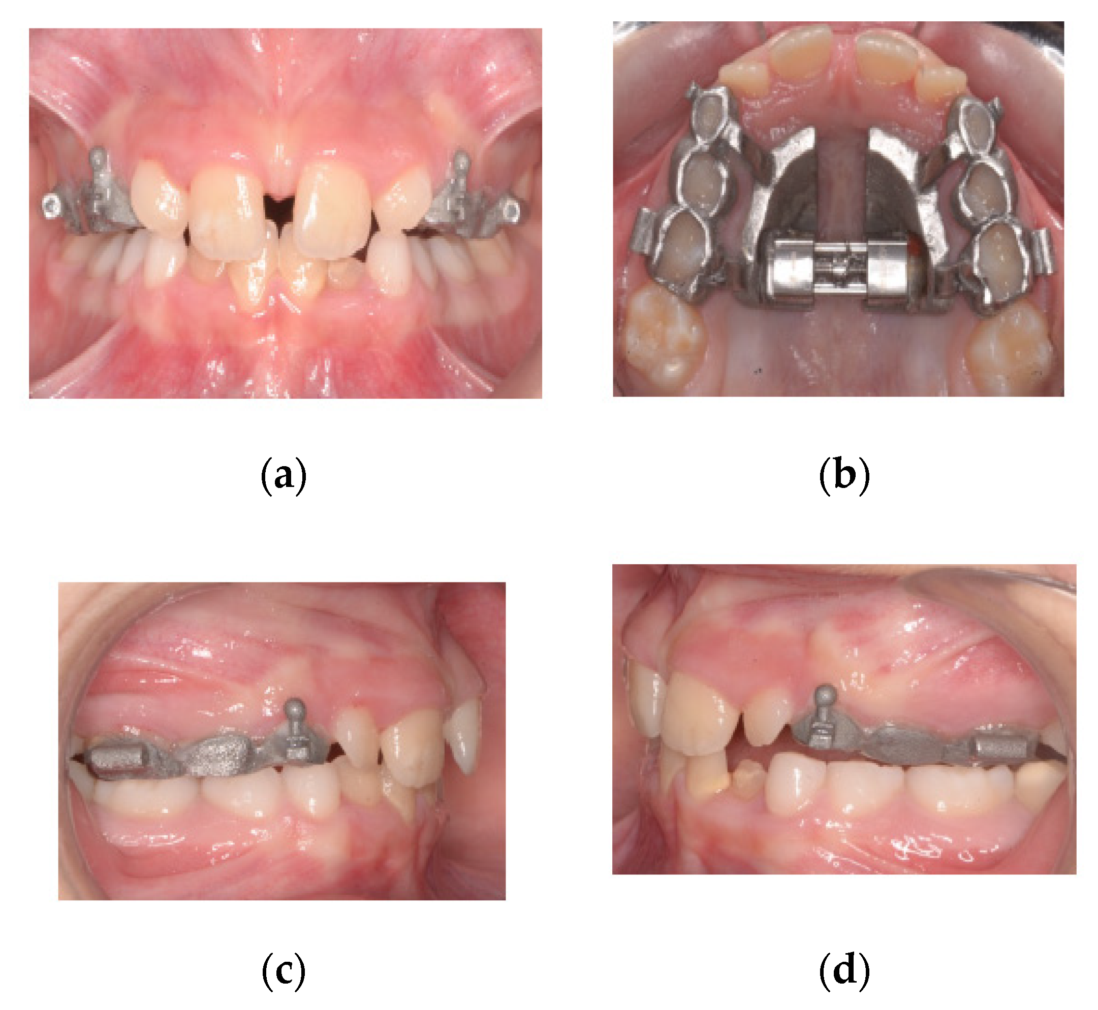 Materials Free Full Text A New Proposal A Digital Flow For The Construction Of A Haas Inspired Rapid Maxillary Expander Hirme Html