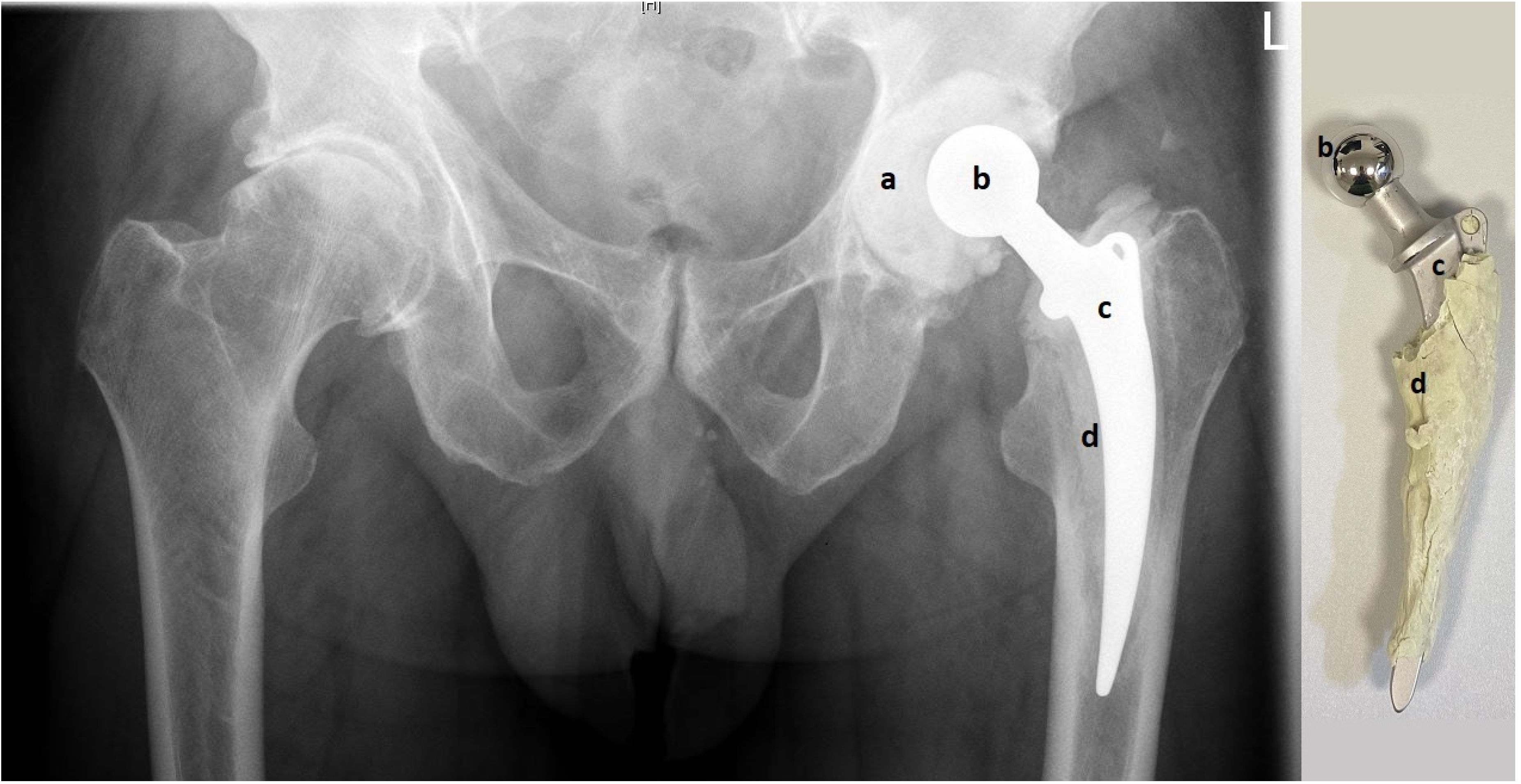 Materials Free FullText Hip Spacers with a MetalonCement