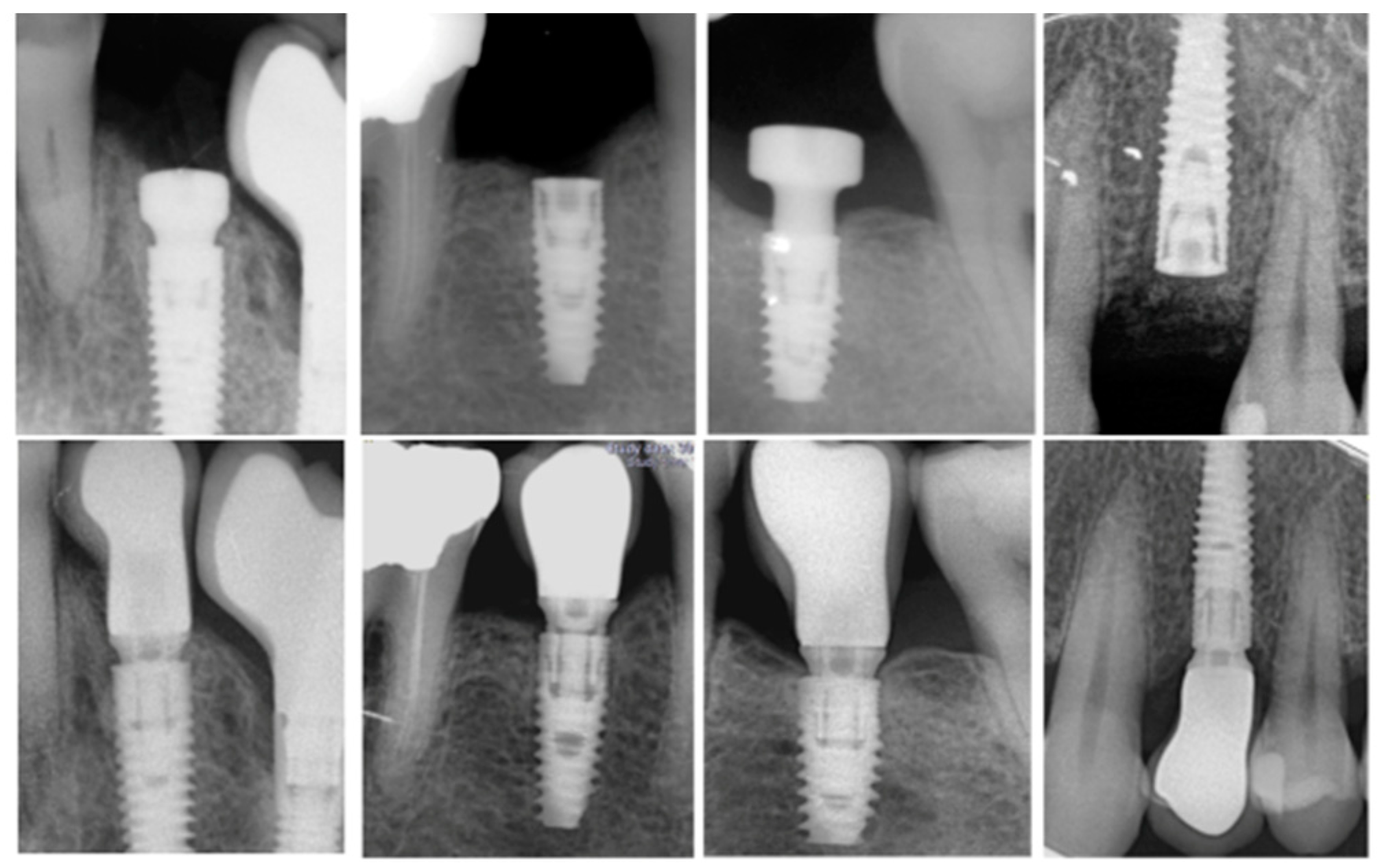 Materials Free FullText Factors Affecting Implant Failure and
