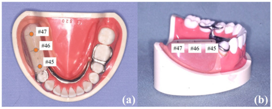 In Vitro Assessment of the Effect of Implant Position on Biomechanical ...