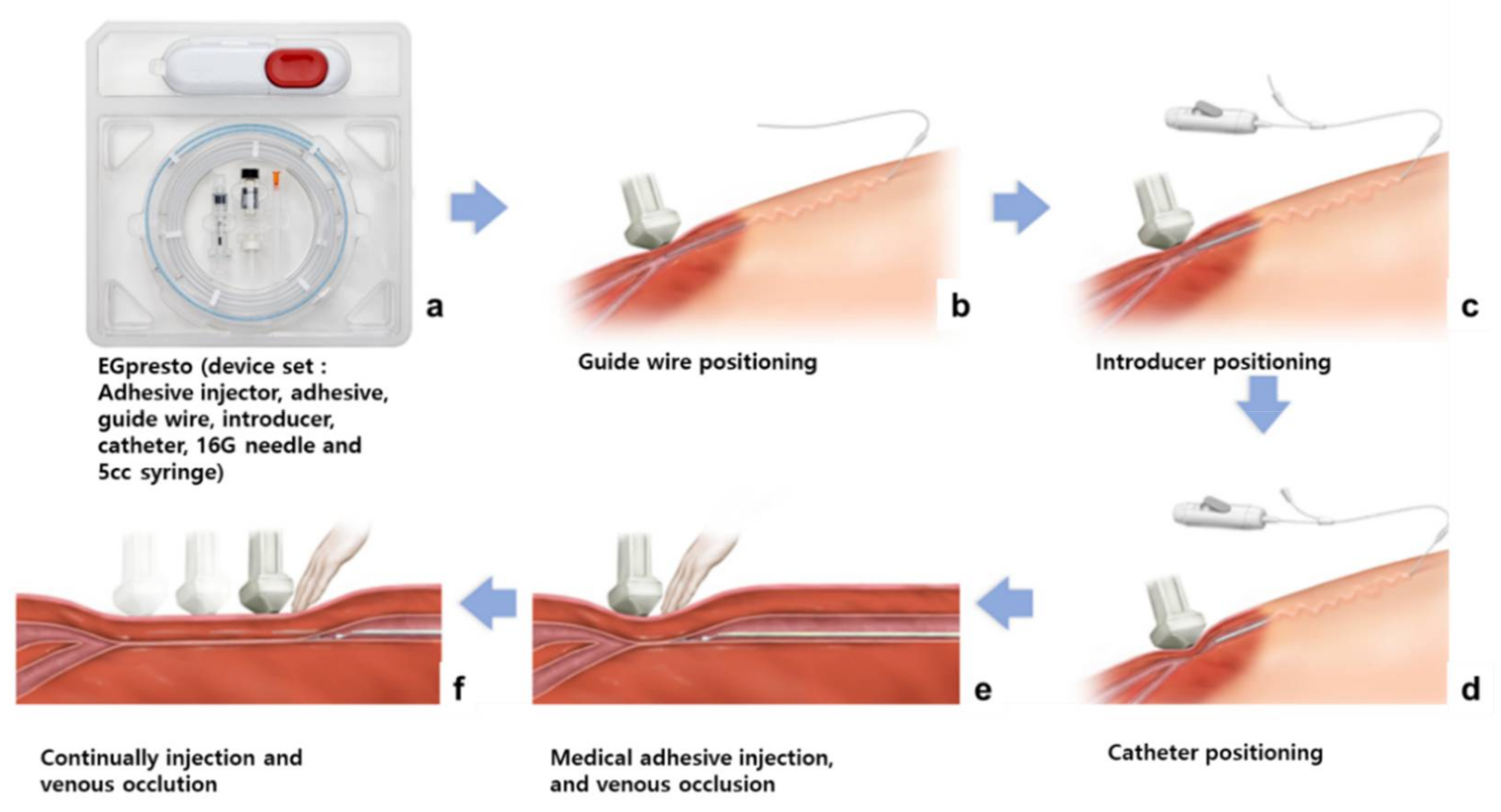 Materials Free FullText In Vivo Animal Study of a Highly Viscous Nbutyl Cyanoacrylate