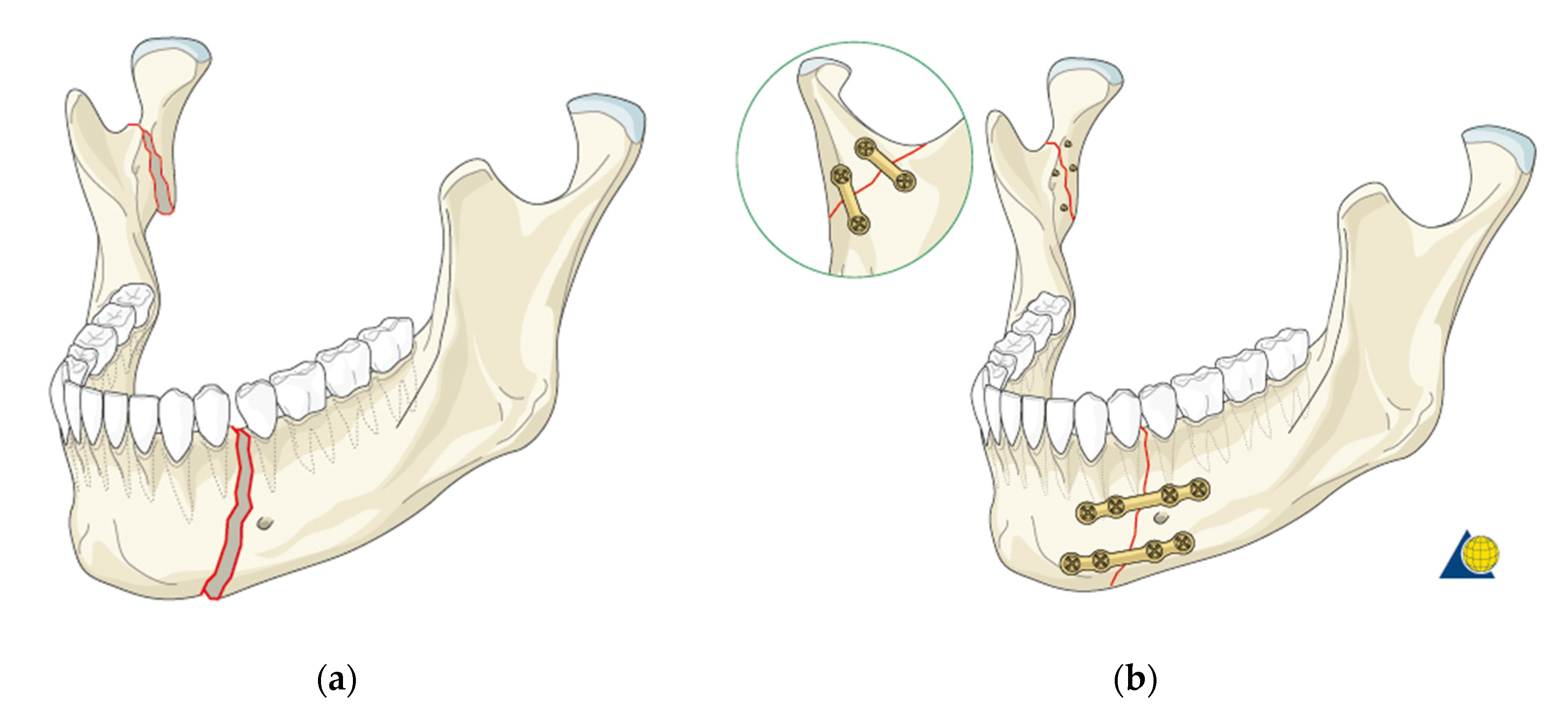 Mandibular Fracture Classification