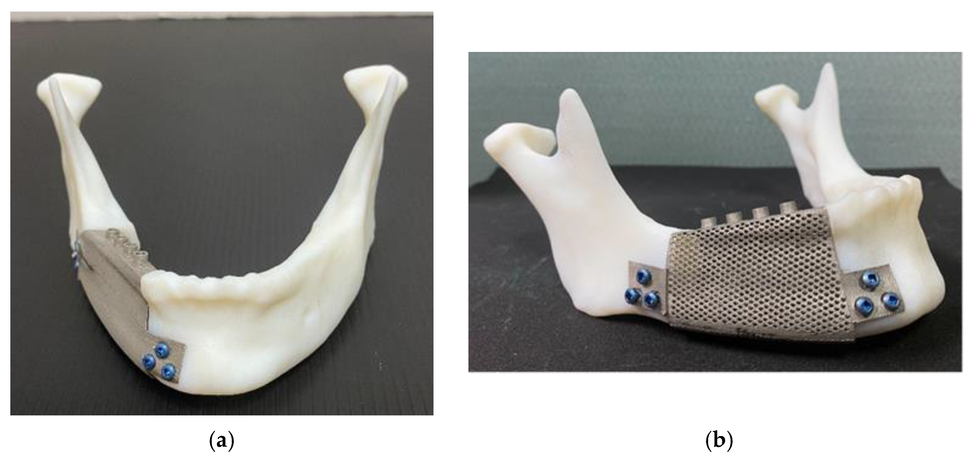 Biomechanical Analyses of Porous Designs of 3DPrinted Titanium Implant