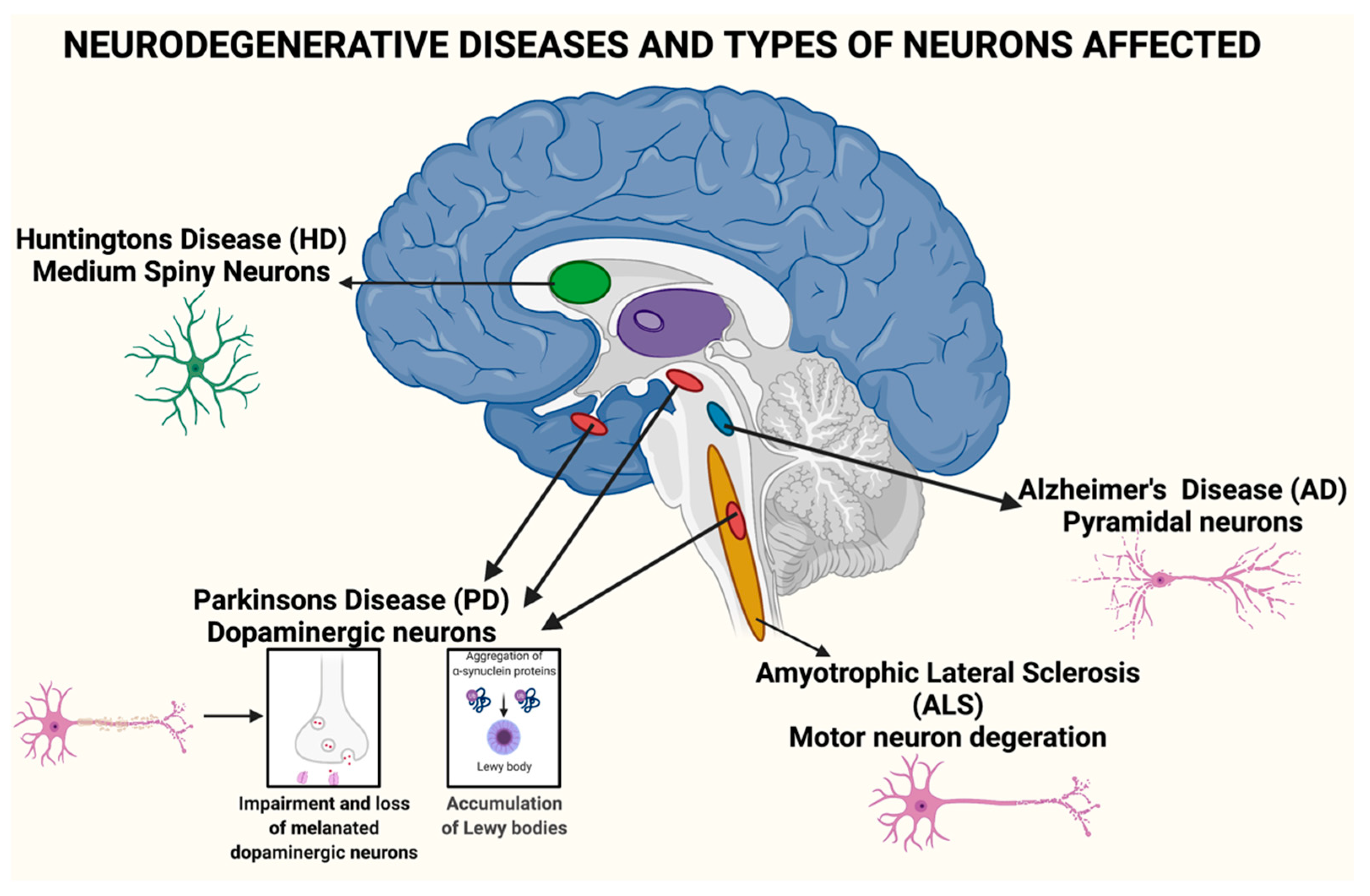 Ayurvedic Treatment of Global LV Hypokinesia