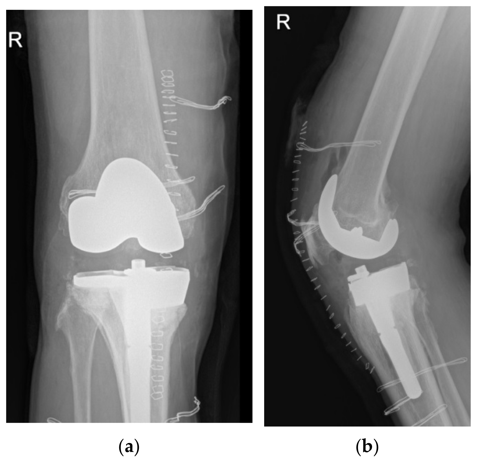Total Knee Replacement with an Uncemented Porous Tantalum Tibia
