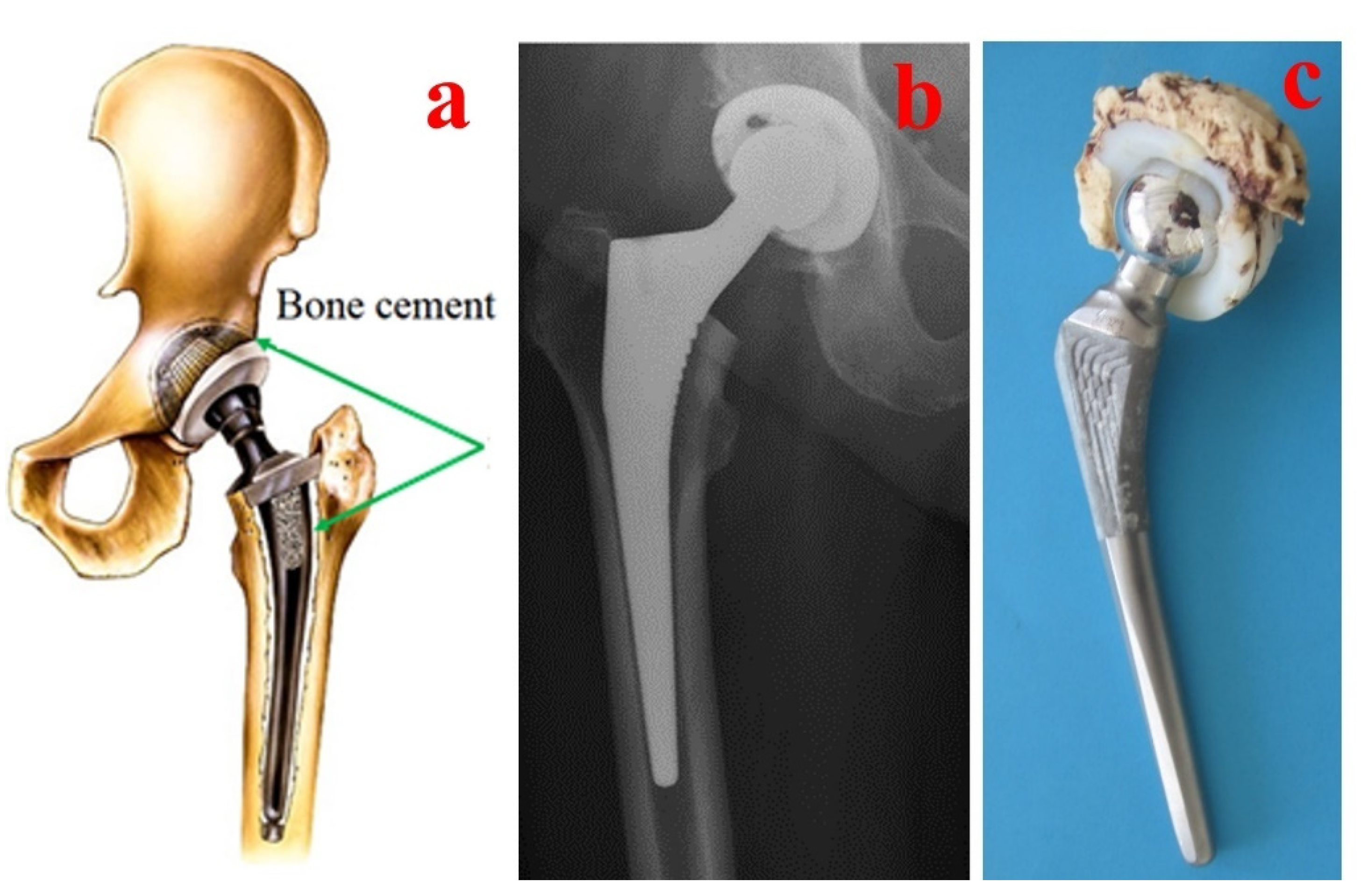 Materials Free FullText Bone Cements Used for Hip Prosthesis