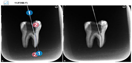 3D reconstructions showing microcracks in the mesial roots of