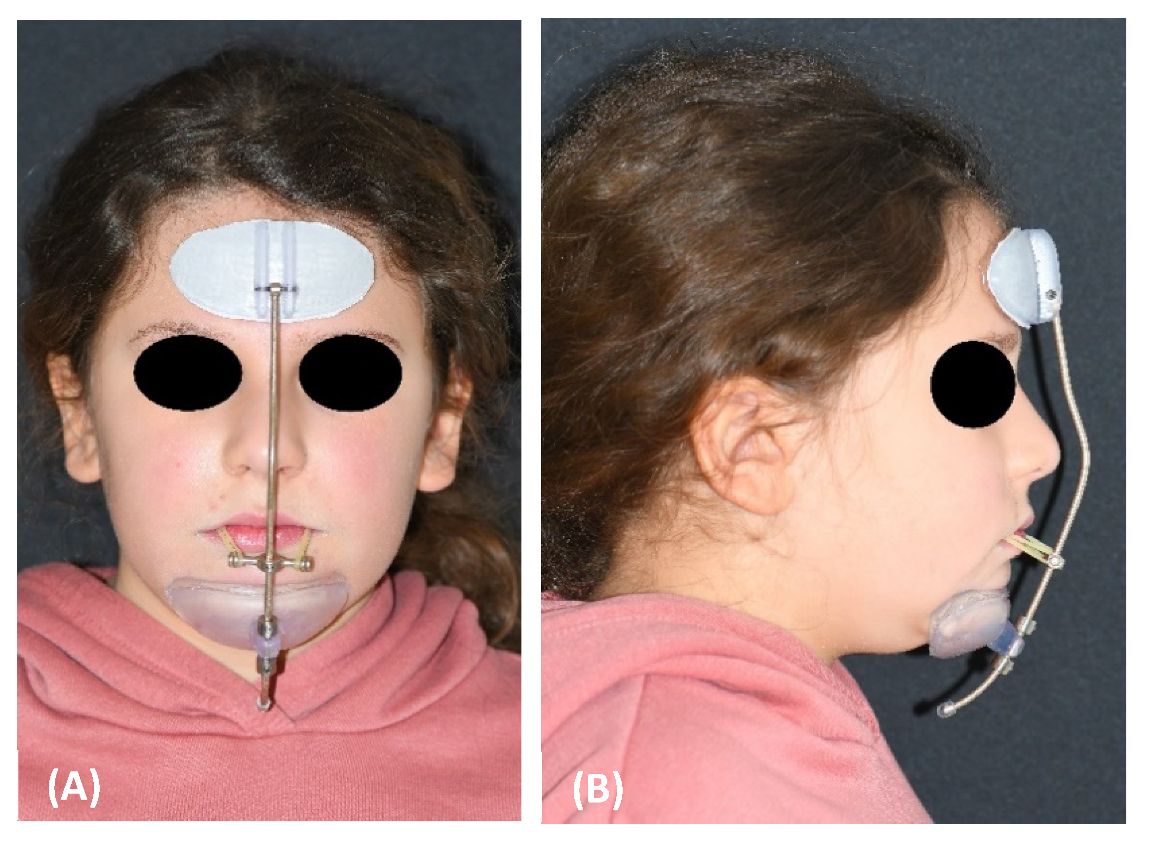 3D Printed Protective Face Mask For Athletes - BioTrib