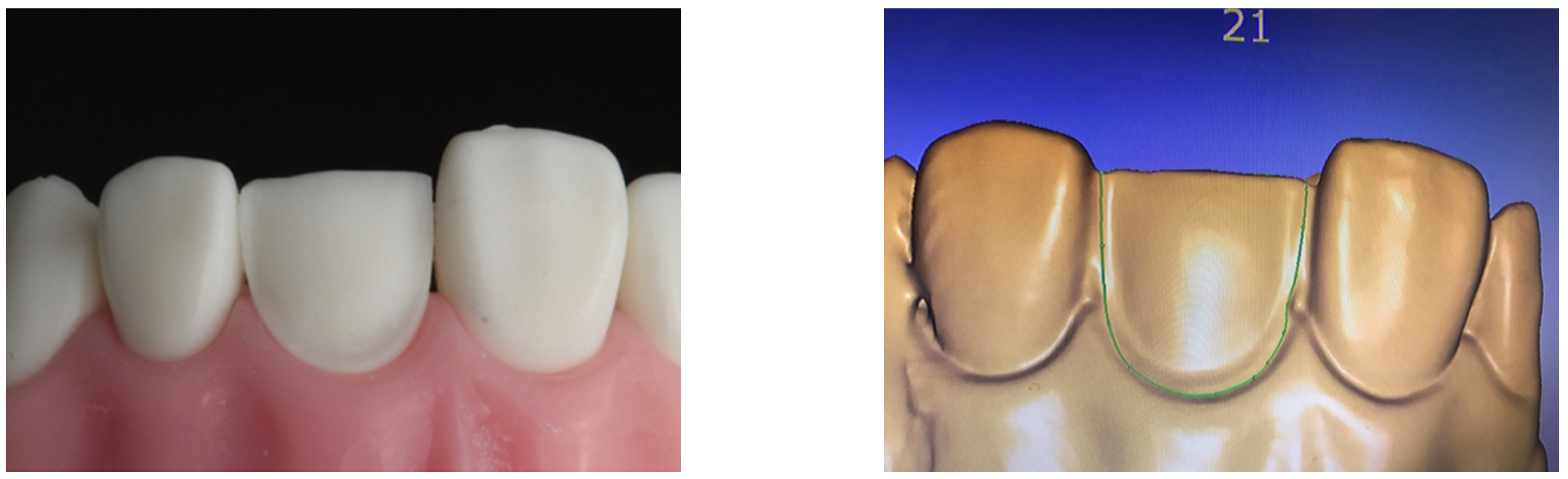 Evaluation of Marginal and Internal Fit of Ceramic Laminate Veneers