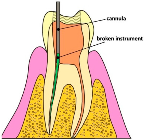 Removing Fractured Endodontic Files with a Tube Technique—The Strength
