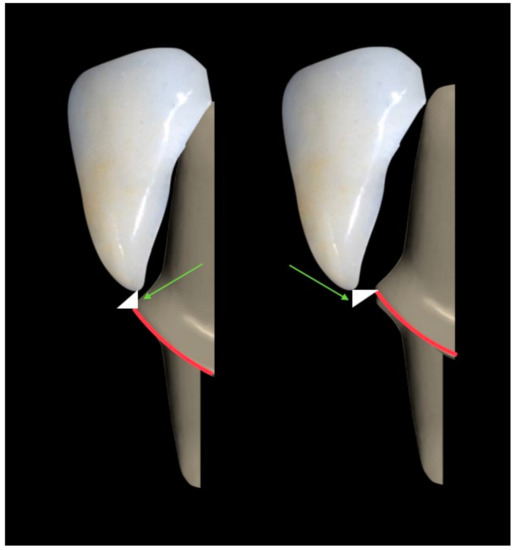 Materials Free FullText Risk Factors with Porcelain Laminate