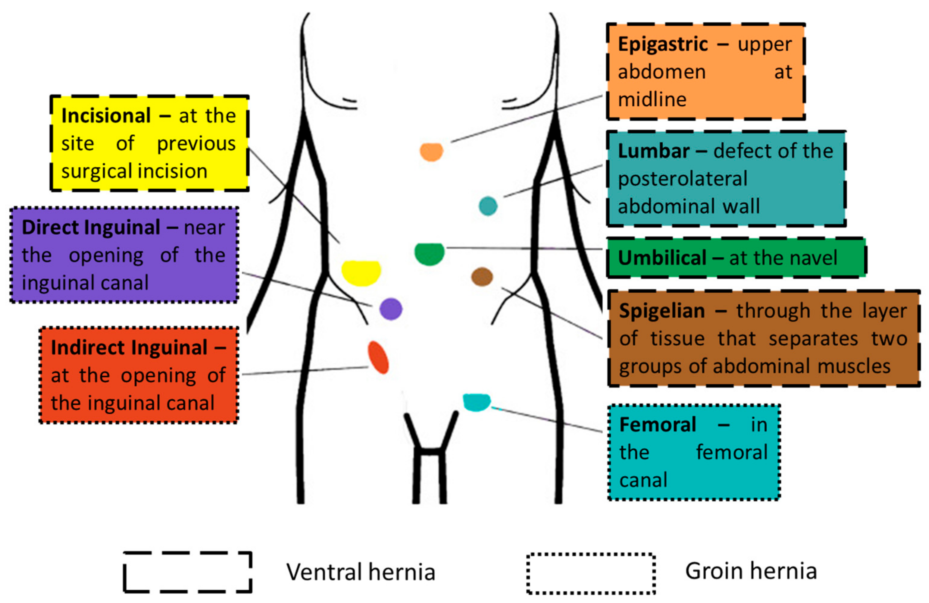 A Review of Abdominal Meshes for Hernia Repair—Current 