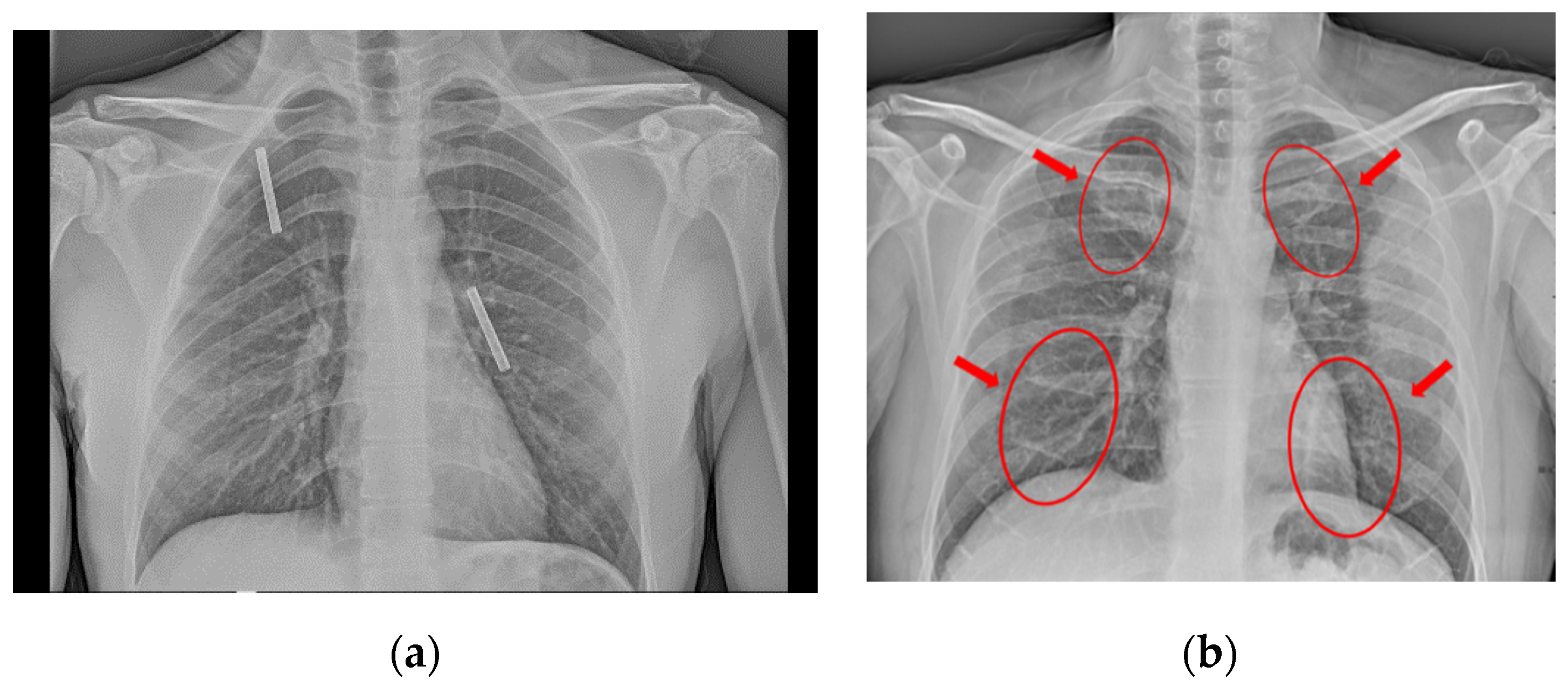 chest x ray pneumonia