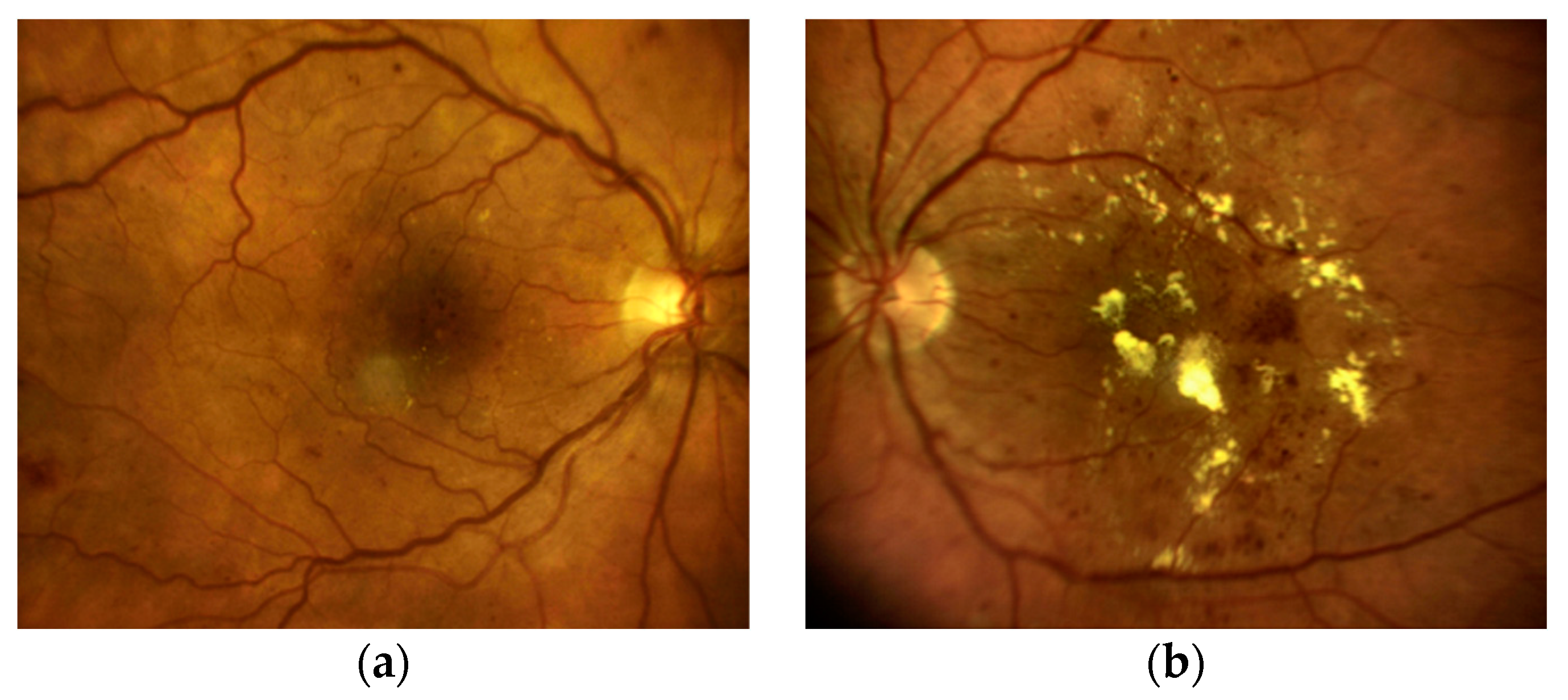 Test ocular Eroshevsky