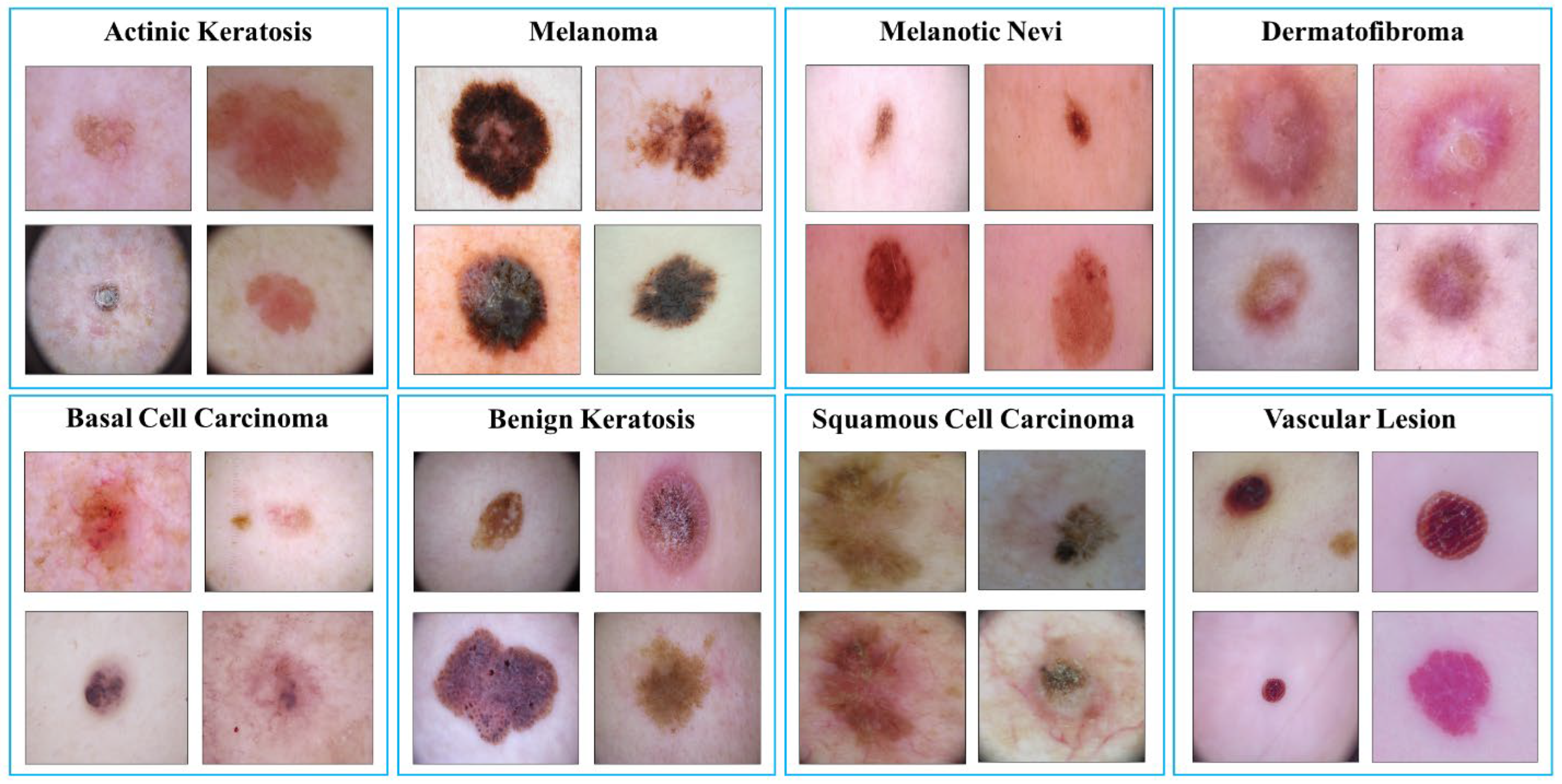 SNC Net Skin Cancer Detection by Integrating Handcrafted and Deep Learning Based Features Using Dermoscopy Images