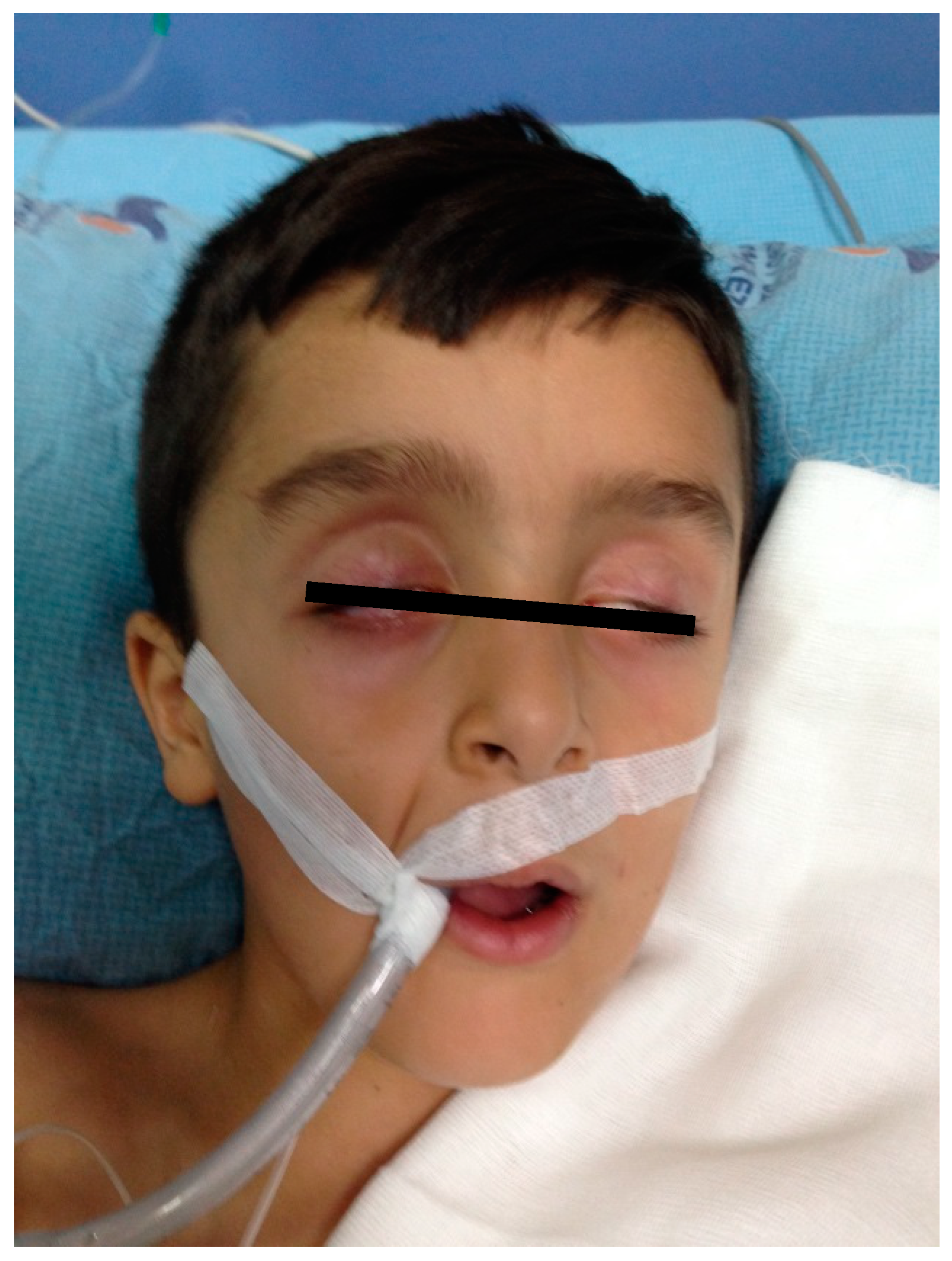 Medicina Free Full Text Is Bilateral Facial Paralysis An Indicator Of Respiratory Outcome In Guillain Barre Syndrome Html Medicina Free Full Text Is Bilateral Facial Paralysis An Indicator Of Respiratory Outcome In Guillain Barre Syndrome Html