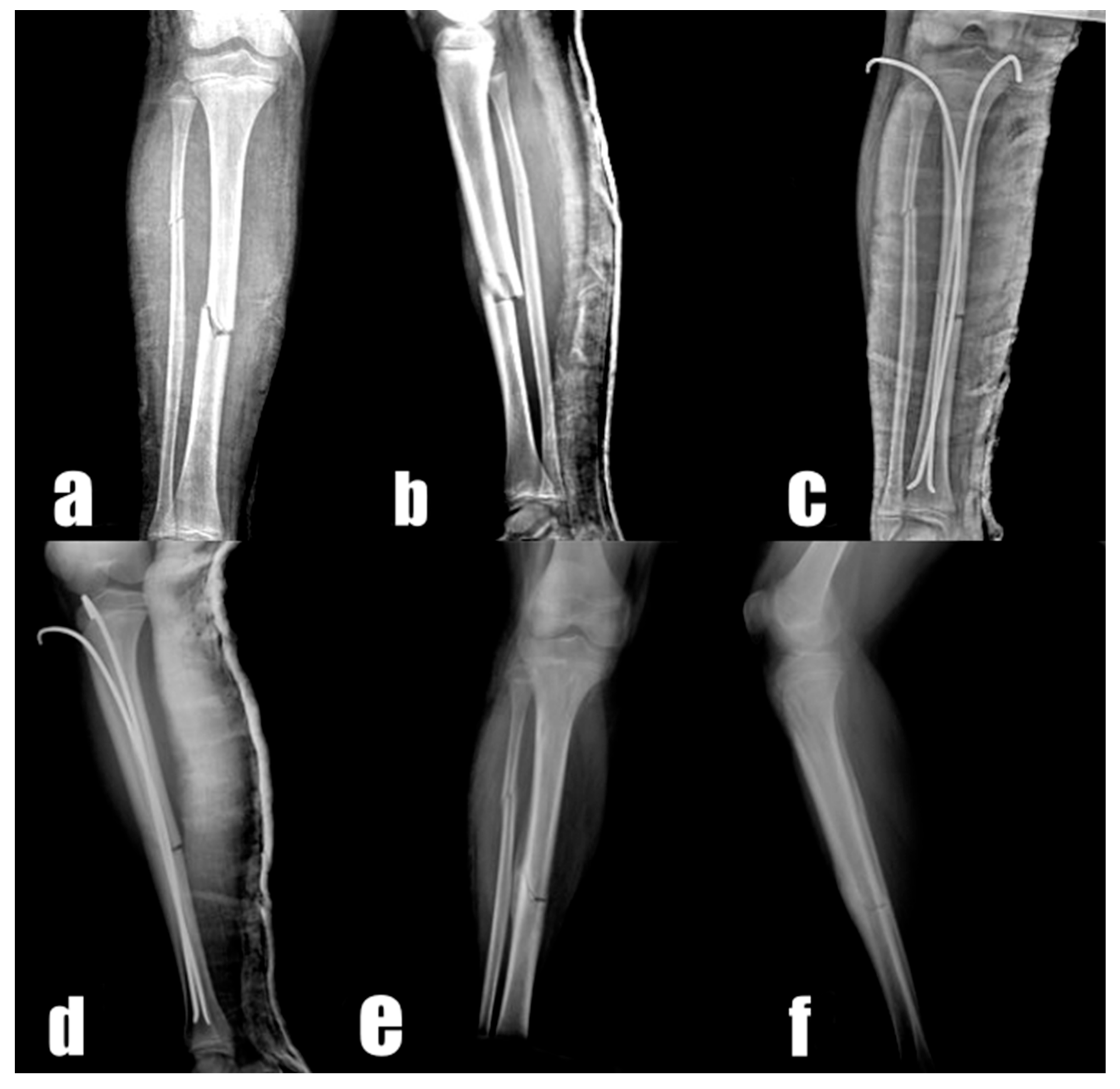 Figure 5 from Intramedullary nailing of proximal tibia fractures--an  anatomical study comparing three lateral starting points for nail  insertion. | Semantic Scholar