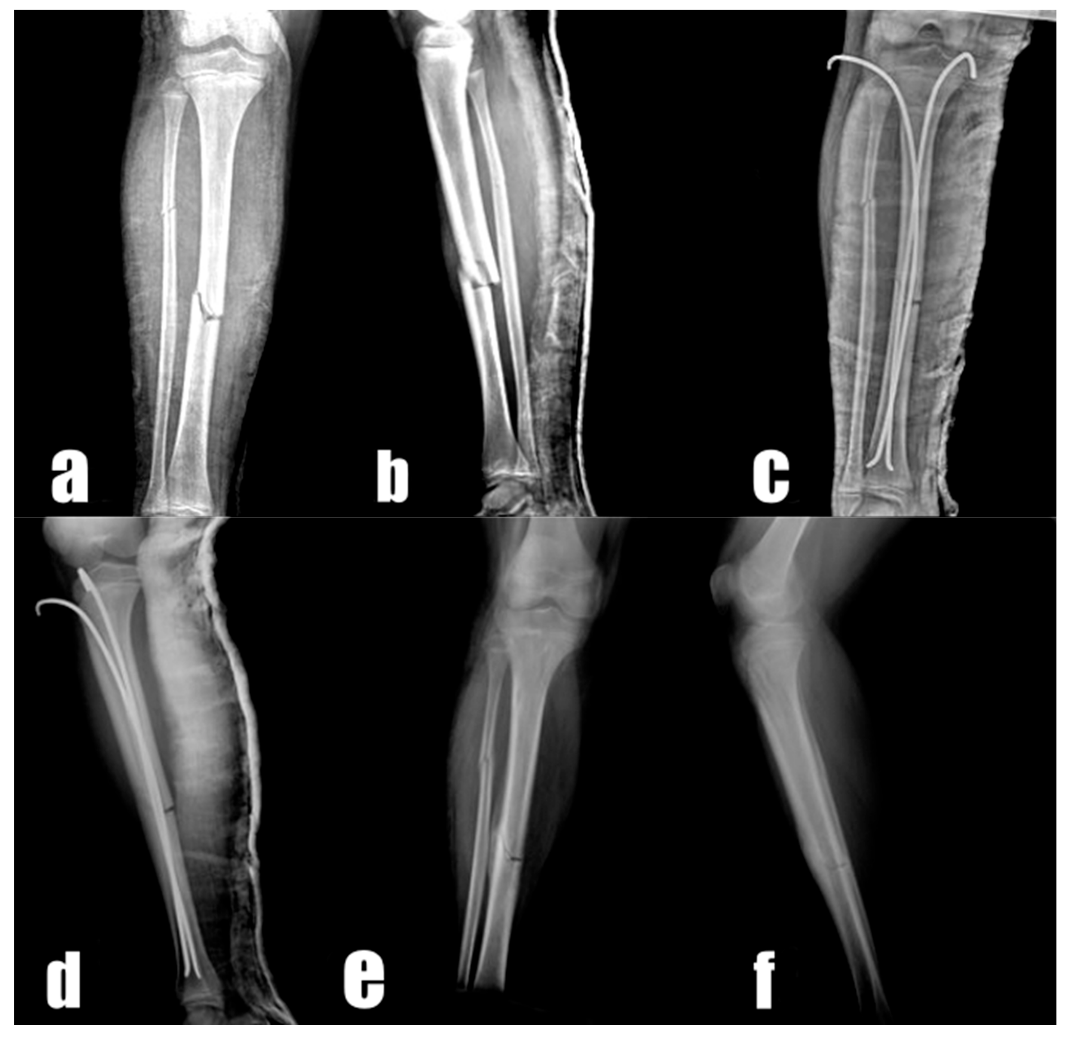 Suprapatellar Insertion Instruments