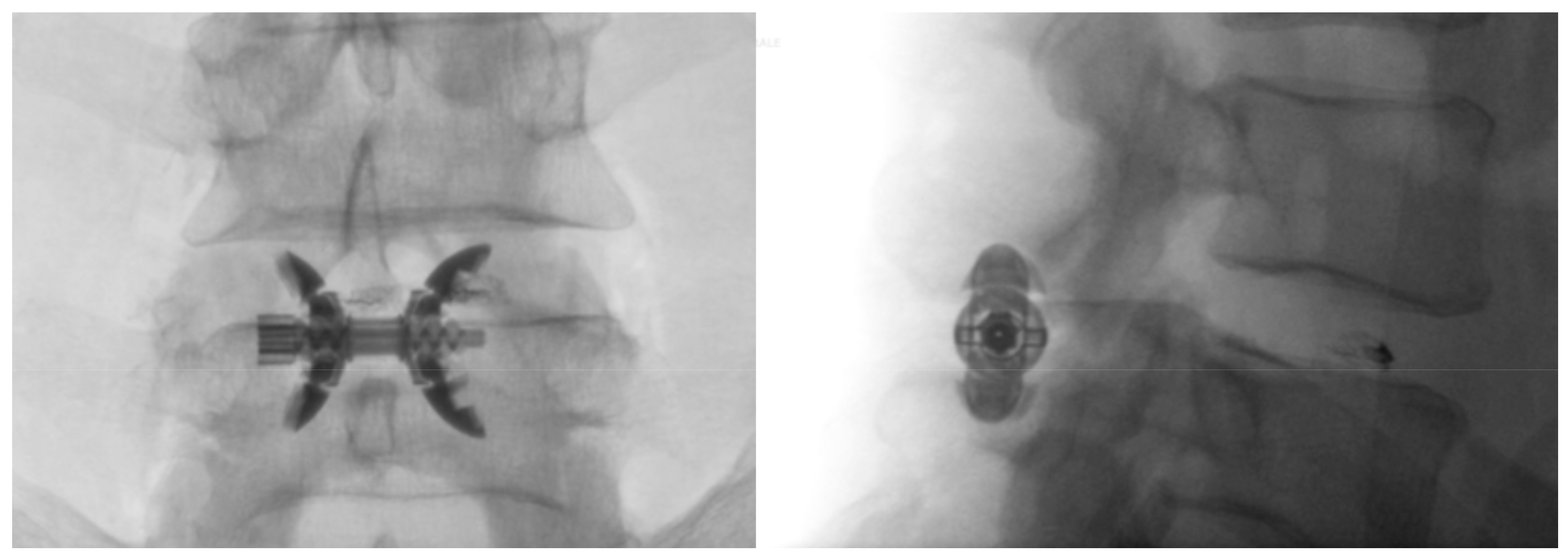 Medicina Free FullText Percutaneous Interspinous Spacer in Spinal