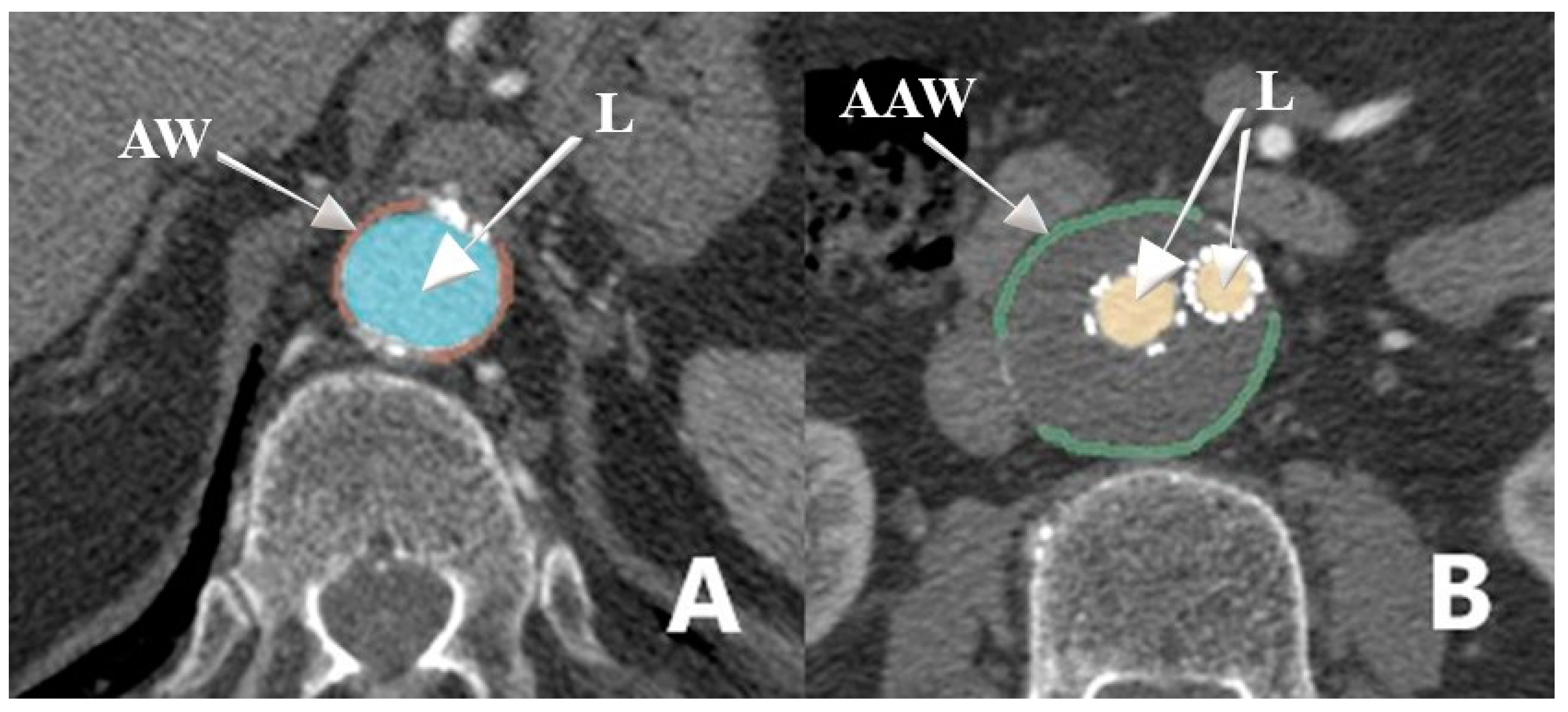 Endovascular Aneurysm Repair: From Bench to Bed