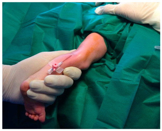 Medicina Free Full Text Umbilical Venous Catheters And Peripherally Inserted Central Catheters Are They Equally Safe In Vlbw Infants A Non Randomized Single Center Study Html