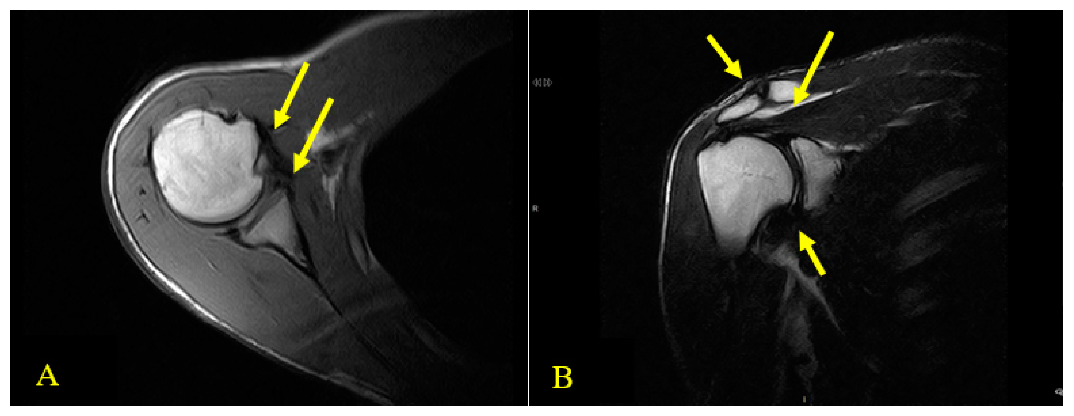 A Rare Consequence after Shoulder Dislocation in a