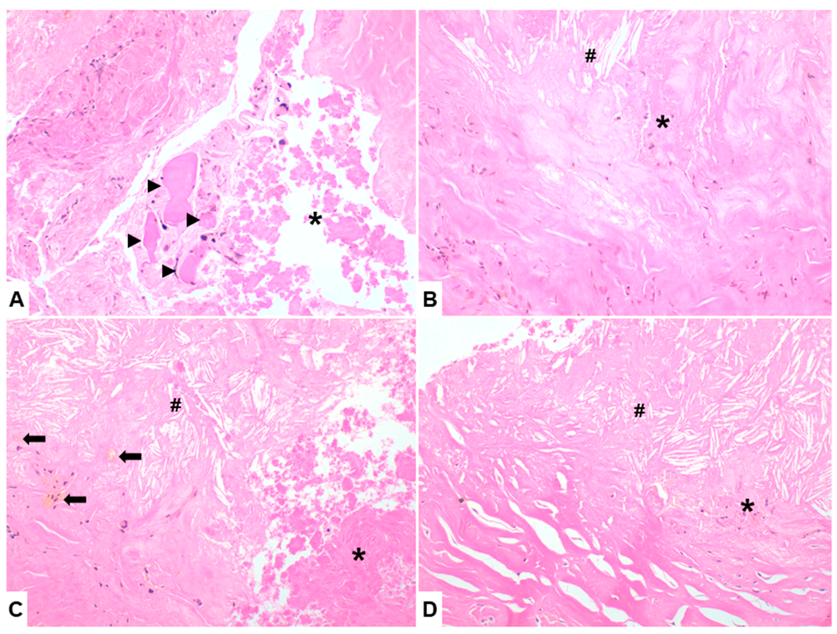 Calcific Myonecrosis of the Leg: A Rare Entity