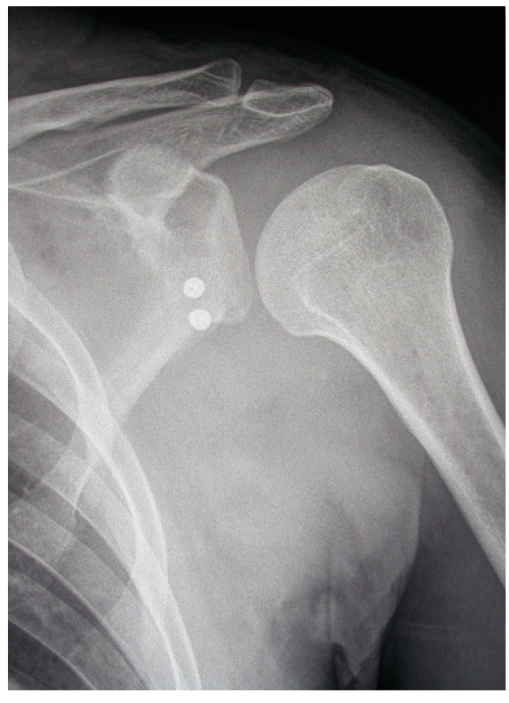 Bone Block Fixation Surgery 