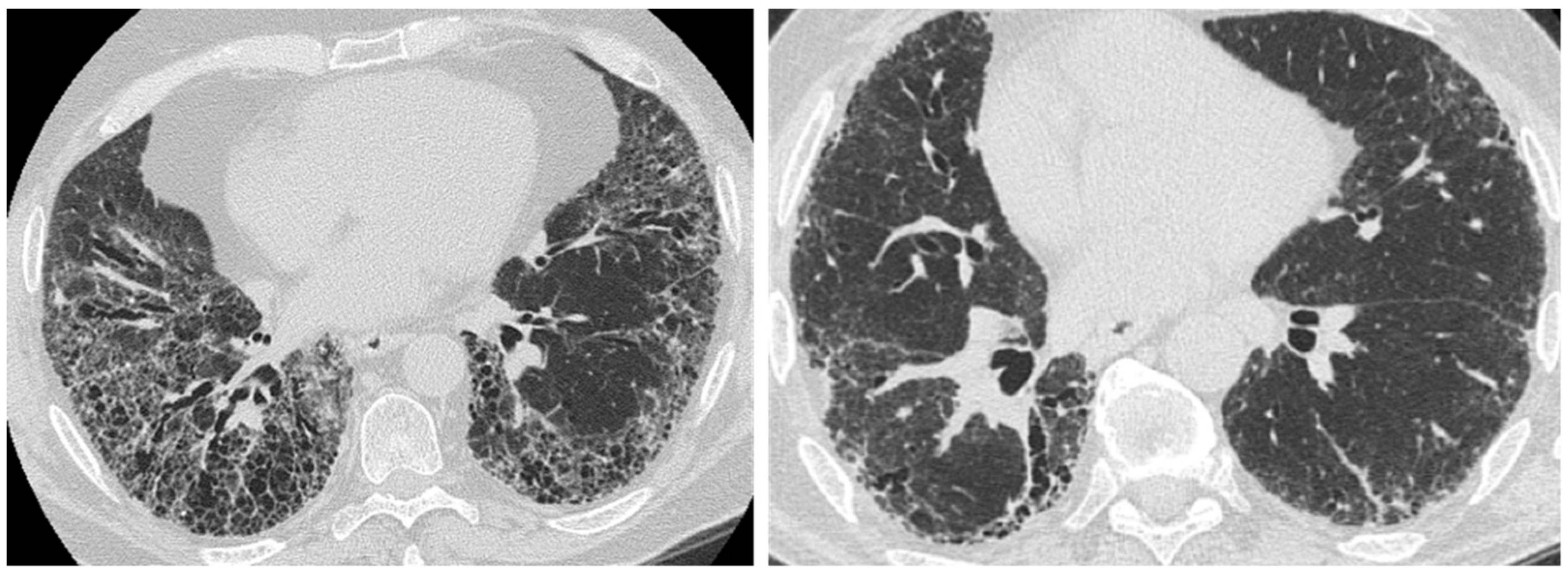 what is the prognosis for stage 4 copd