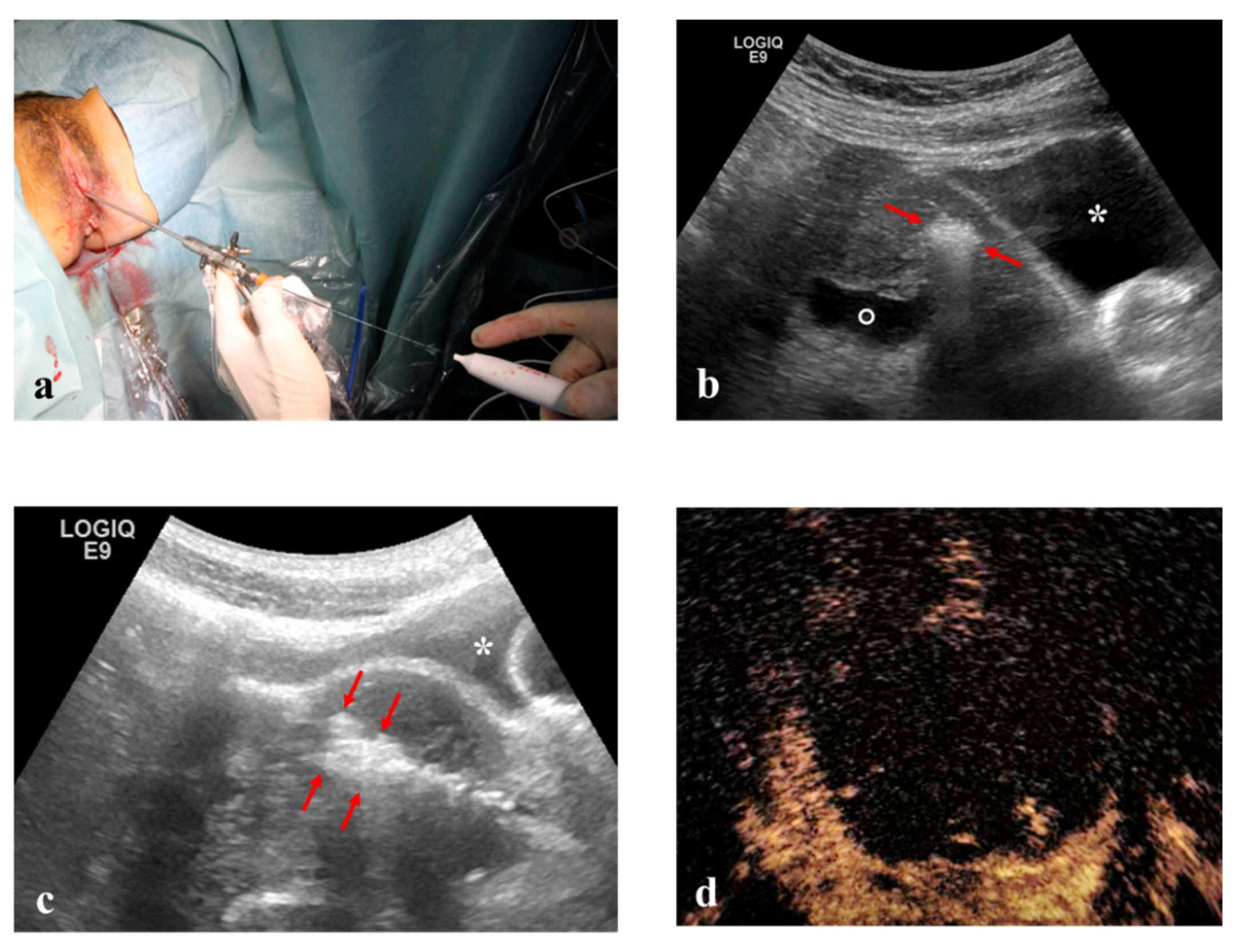 Endometrial Ablation Weight Gain 80 - 0p7v22b
